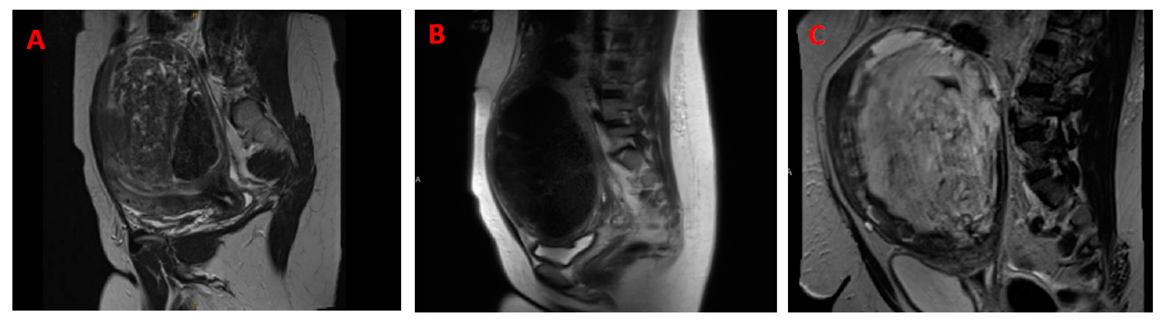 Cells | Free Full-Text | Comprehensive Review of Uterine Leiomyosarcoma:  Pathogenesis, Diagnosis, Prognosis, and Targeted Therapy