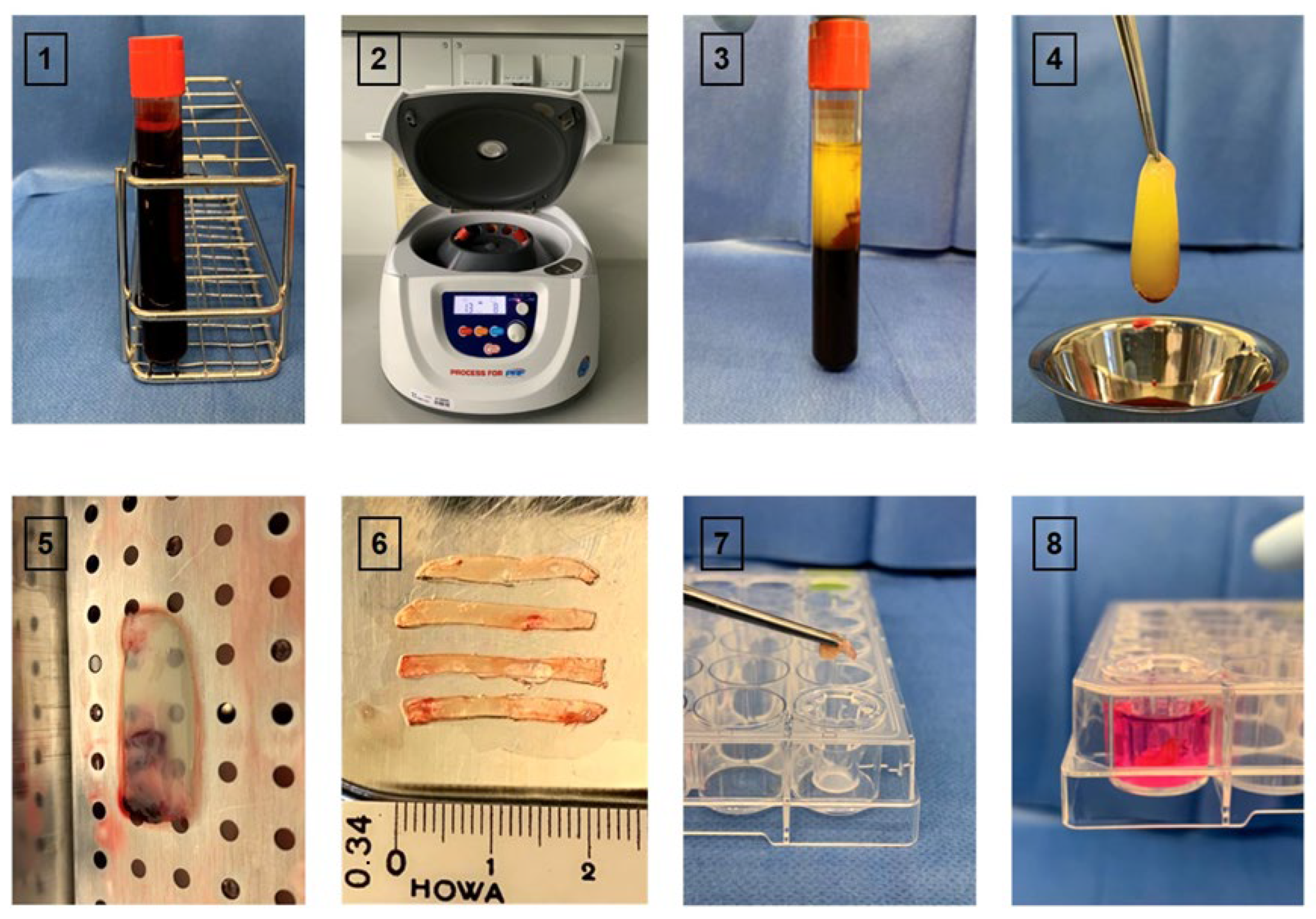 The Impact of Surgical Trauma-Activated Platelet-Rich Fibrin on ...