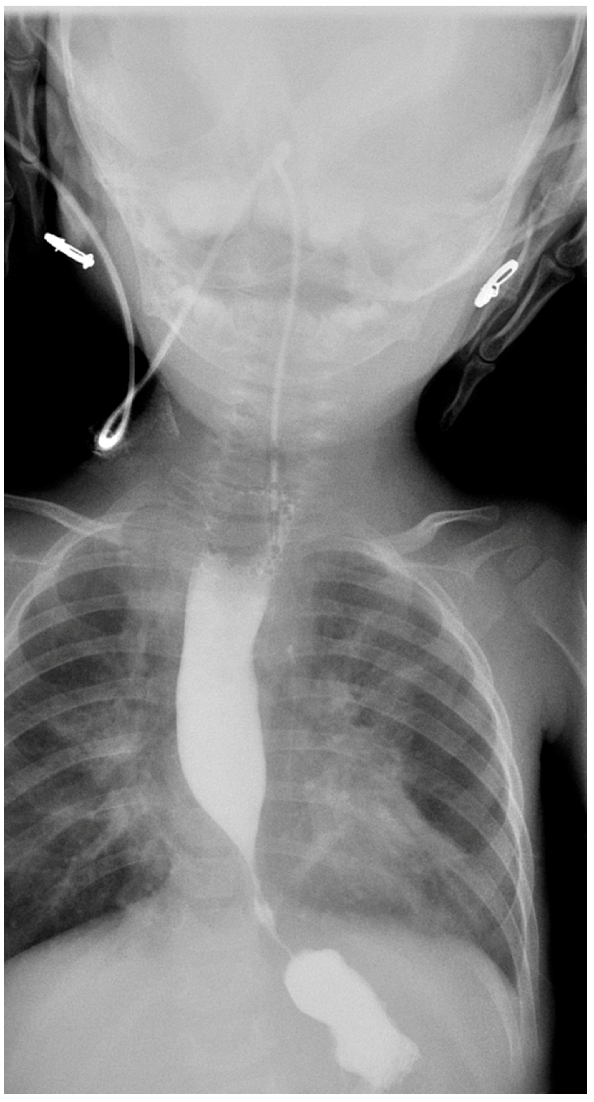 Esophageal compression by a common left pulmonary venous trunk