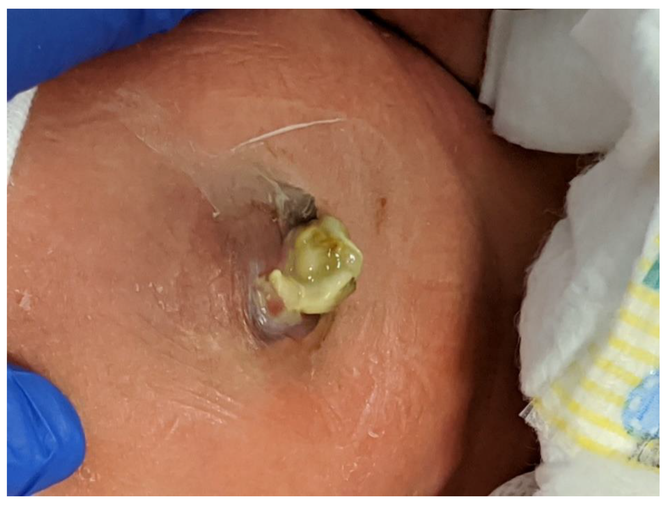 PDF] Spontaneous rupture of a congenital umbilical hernia in an infant: a  rare complication