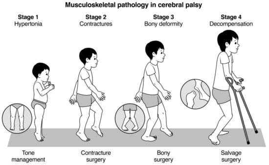 Children | Free Full-Text | Musculoskeletal Pathology in Cerebral Palsy: A  Classification System and Reliability Study