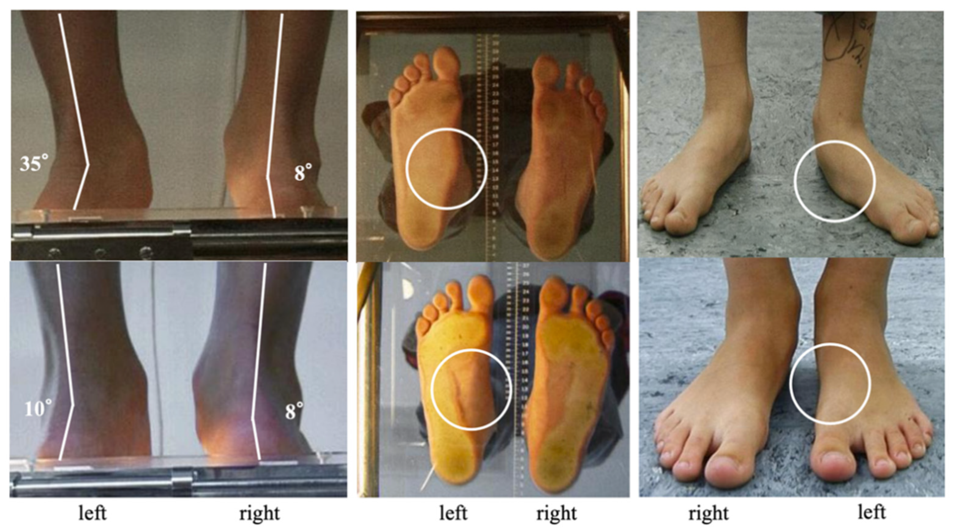 Pediatric - Flexible Flatfoot, Foot & Ankle