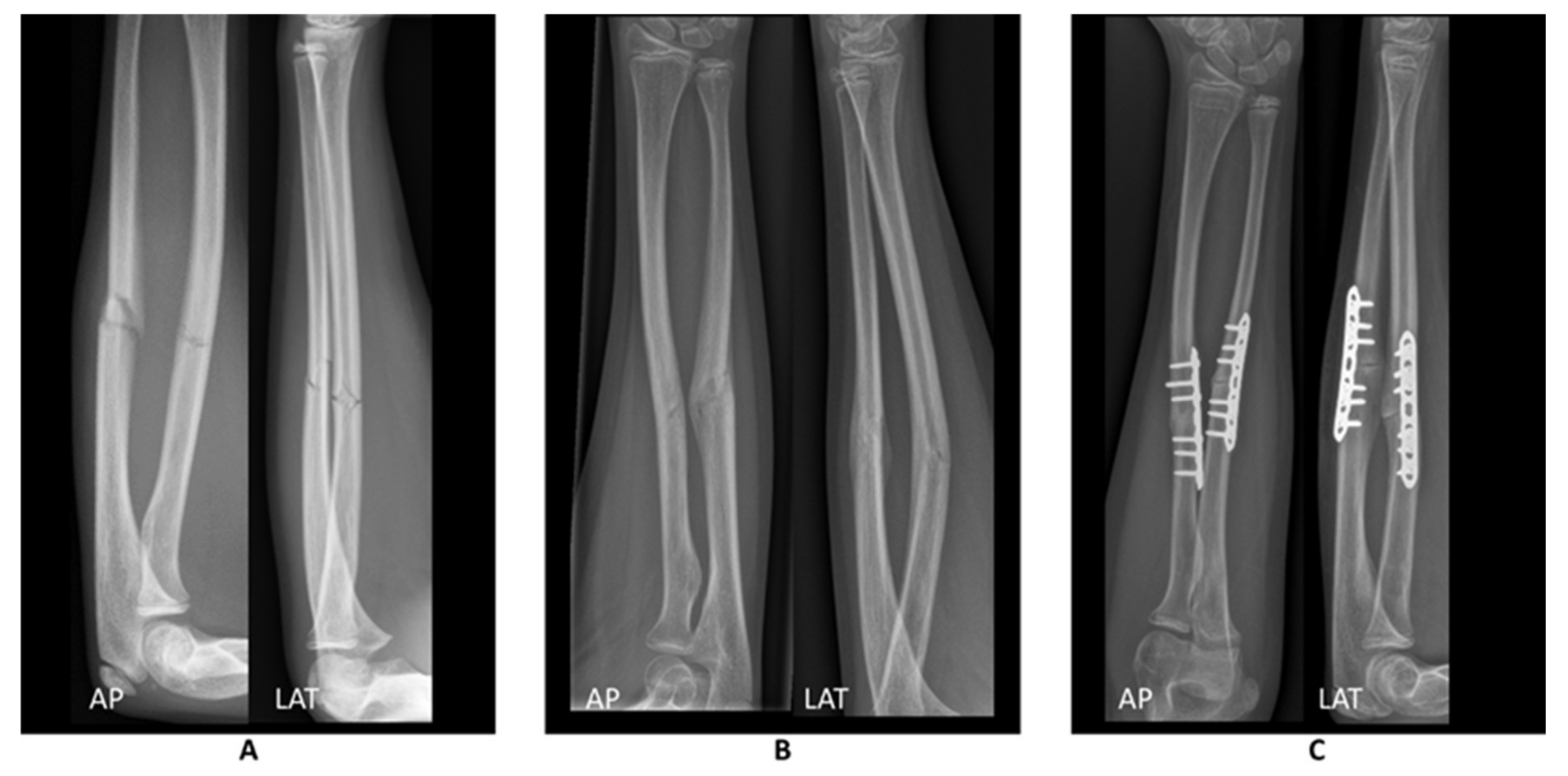 Ulna Bone Fracture Ulna Bone Fracture