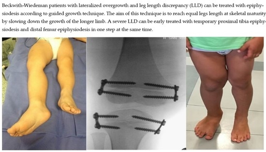 Limb lengthening surgeries are real. But how safe are they? - Interesting  Engineering