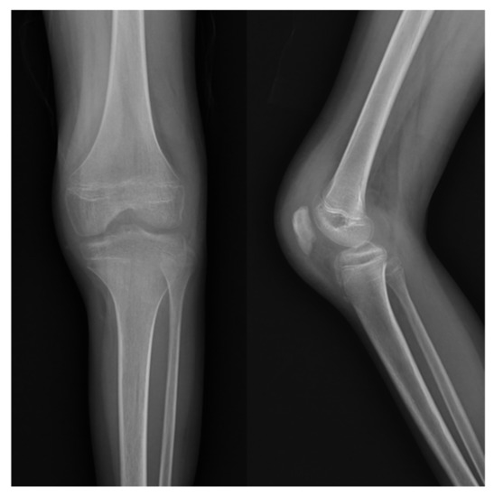 Patellar Osteomyelitis in a 9-Year-Old Patient with Chronic ...