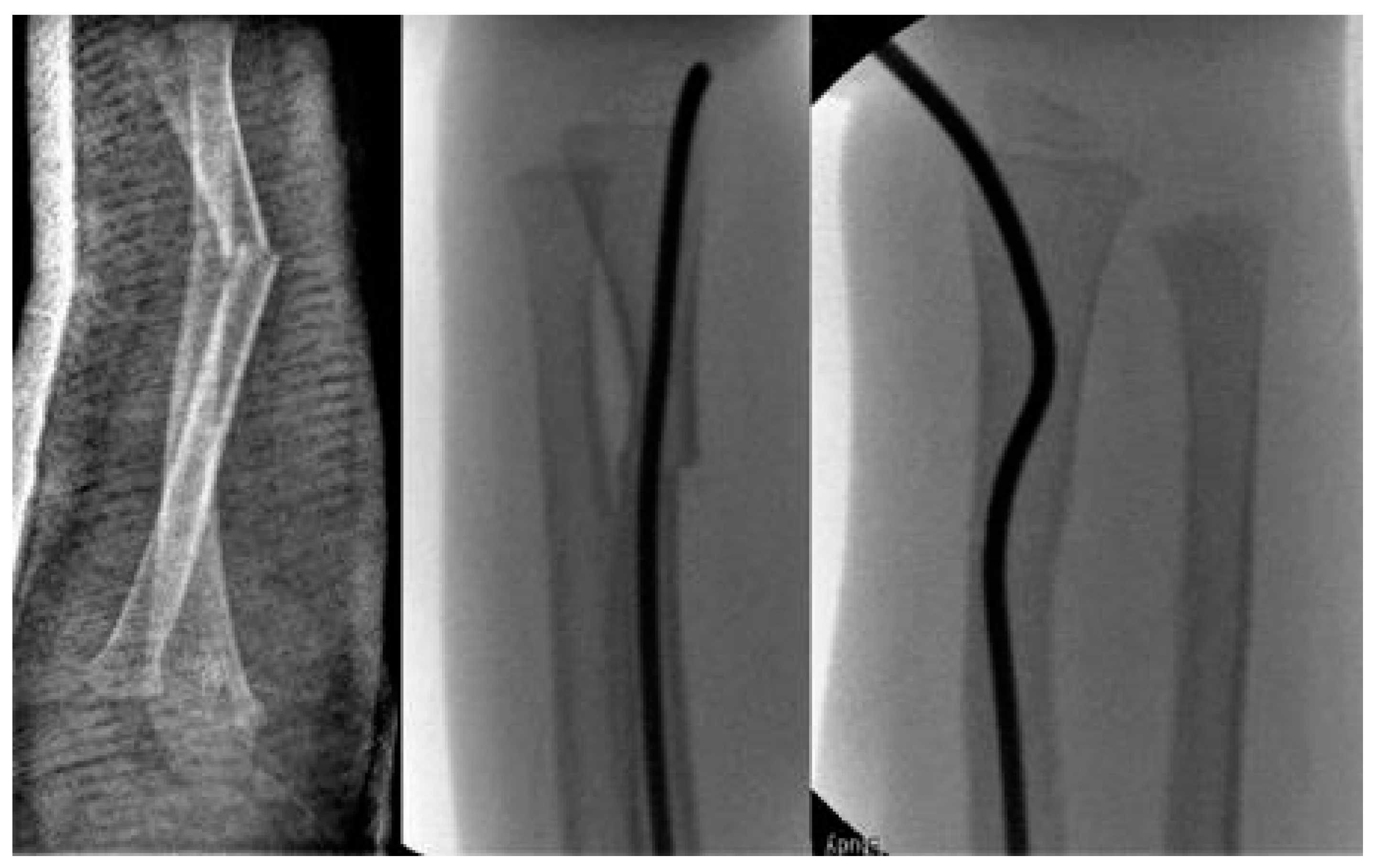 Closed reduction by trans-physealantegrade elastic stable intramedullary  nailing in acute pediatric Monteggia fractures: a repor
