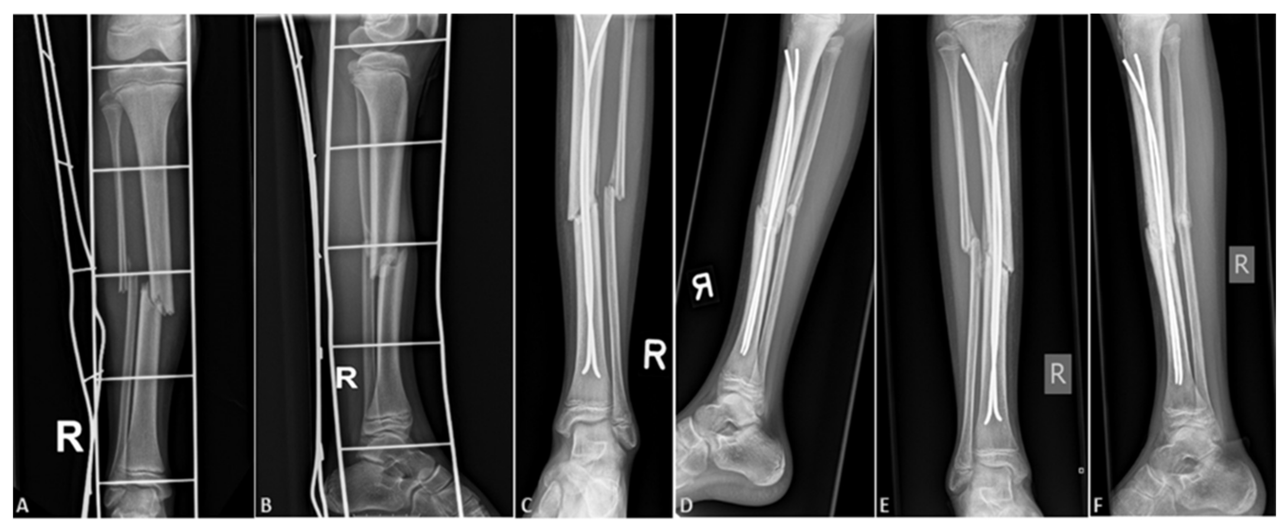 6. Radiographic Evaluation of Brooker-Wills Interlocking Intramedullary Nail Design in Tibial Fractures - wide 9