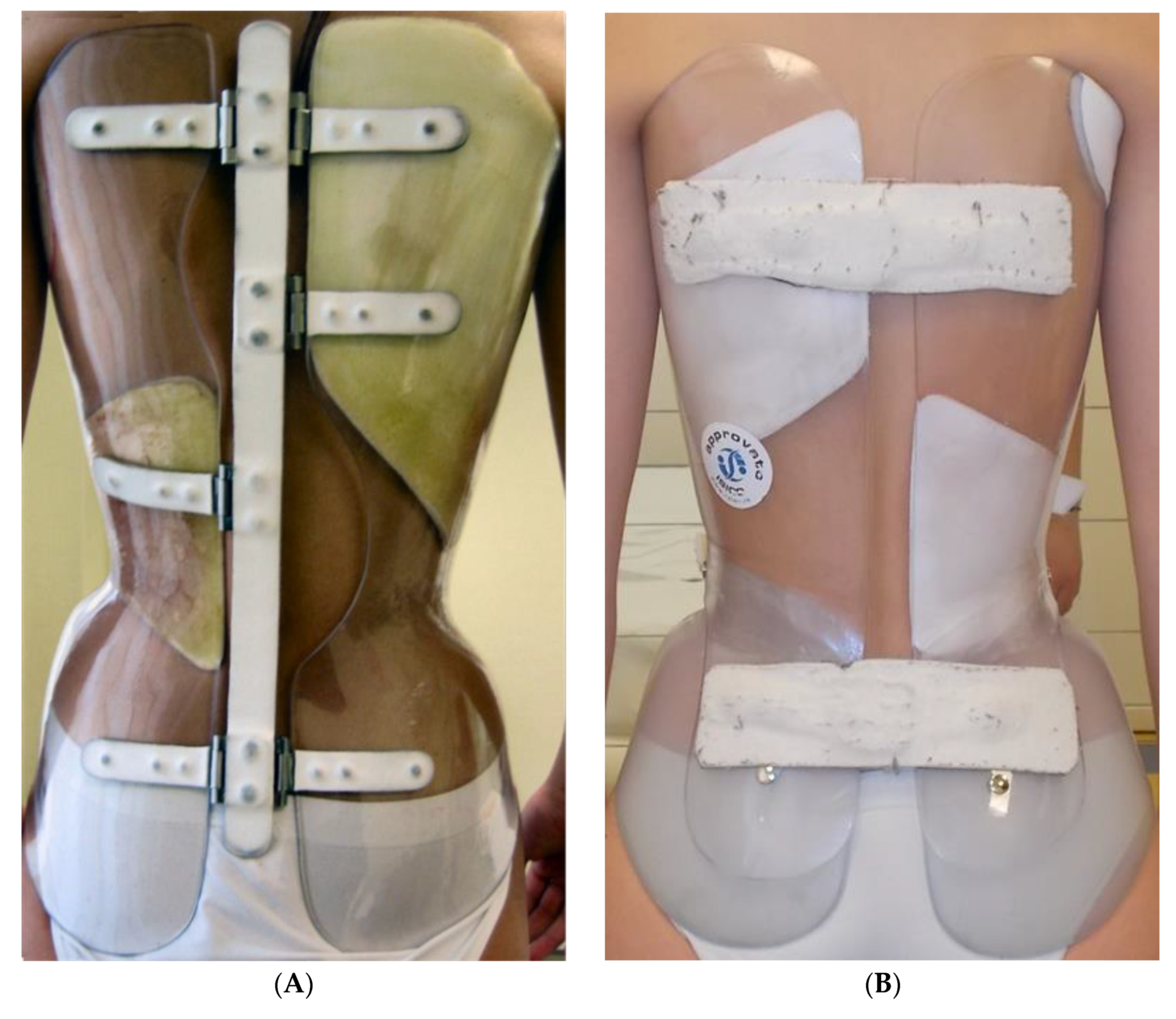 The Boston brace (A) and a patient wearing the brace (B) in