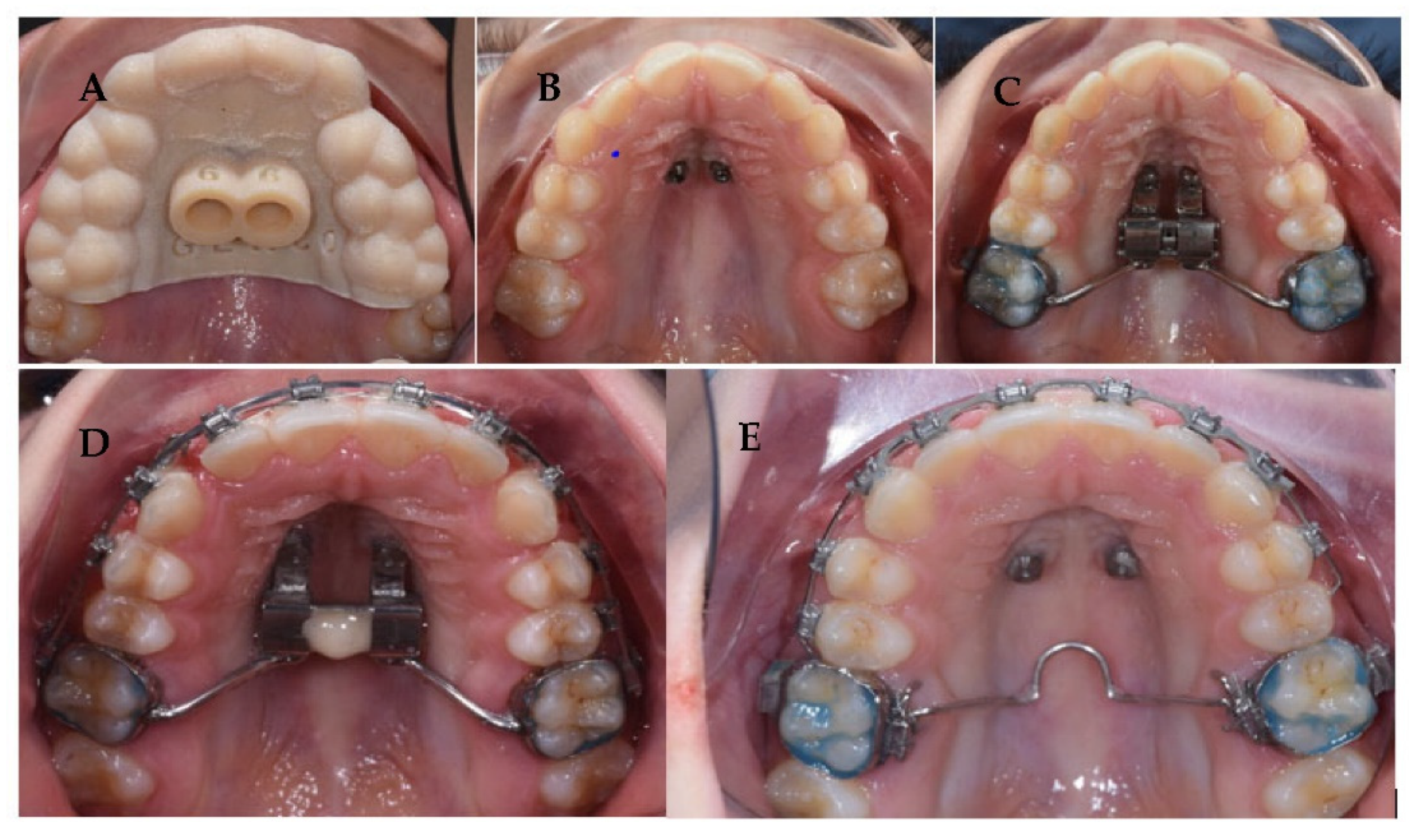 Children Free Full-Text Rapid Maxillary Expansion On The