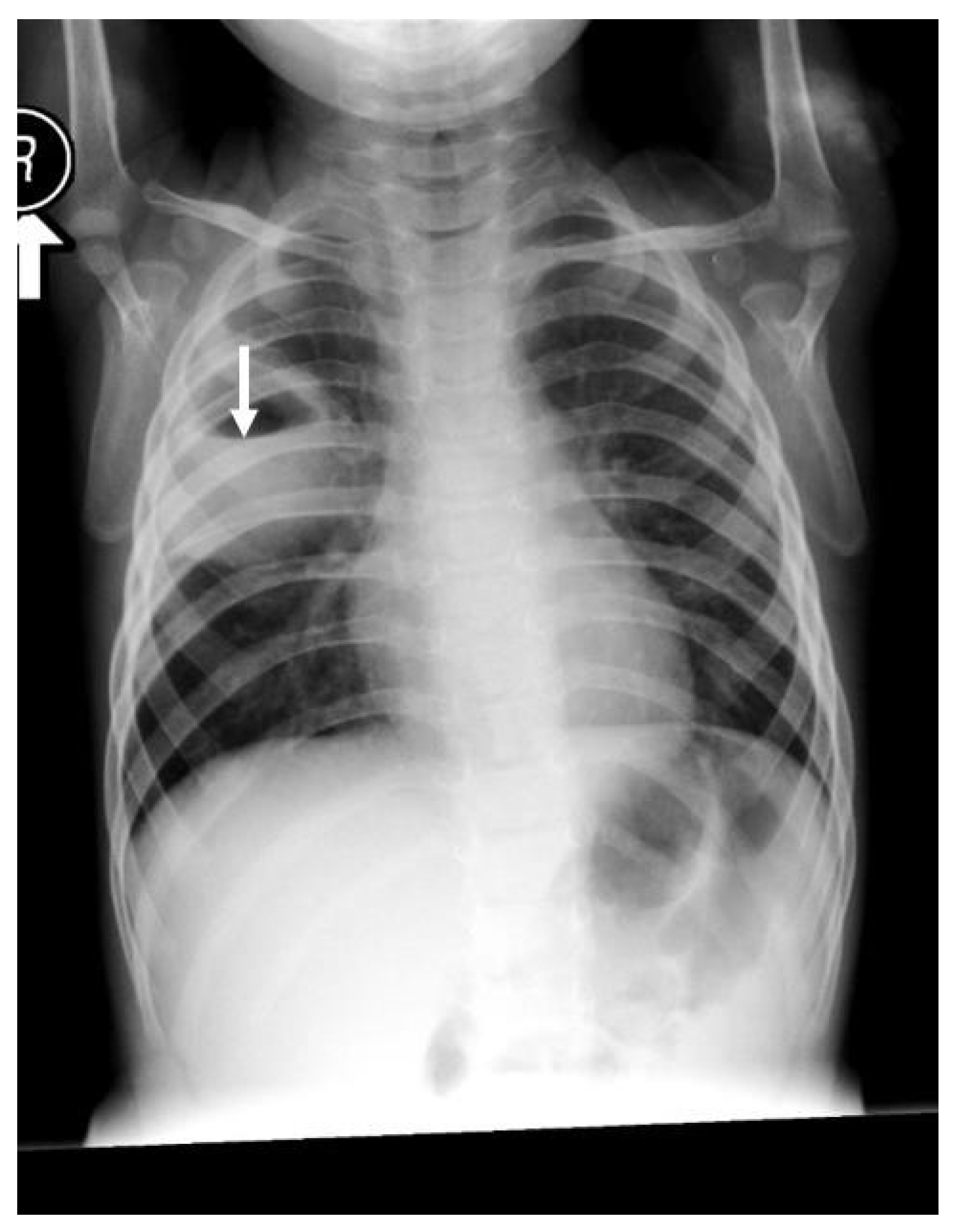 lung abscess x ray