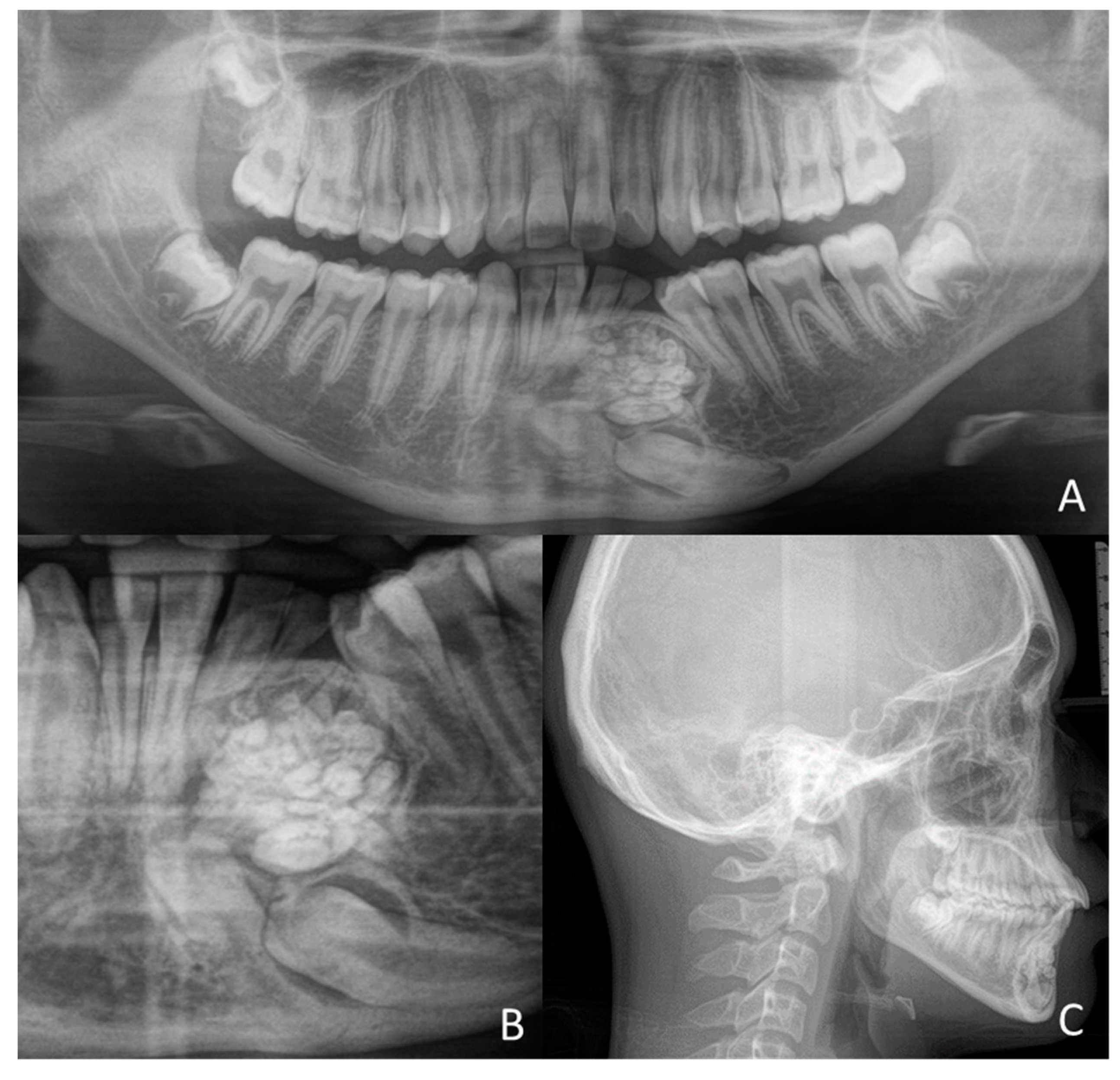 Odontoma Pathology Odontoma Pathology