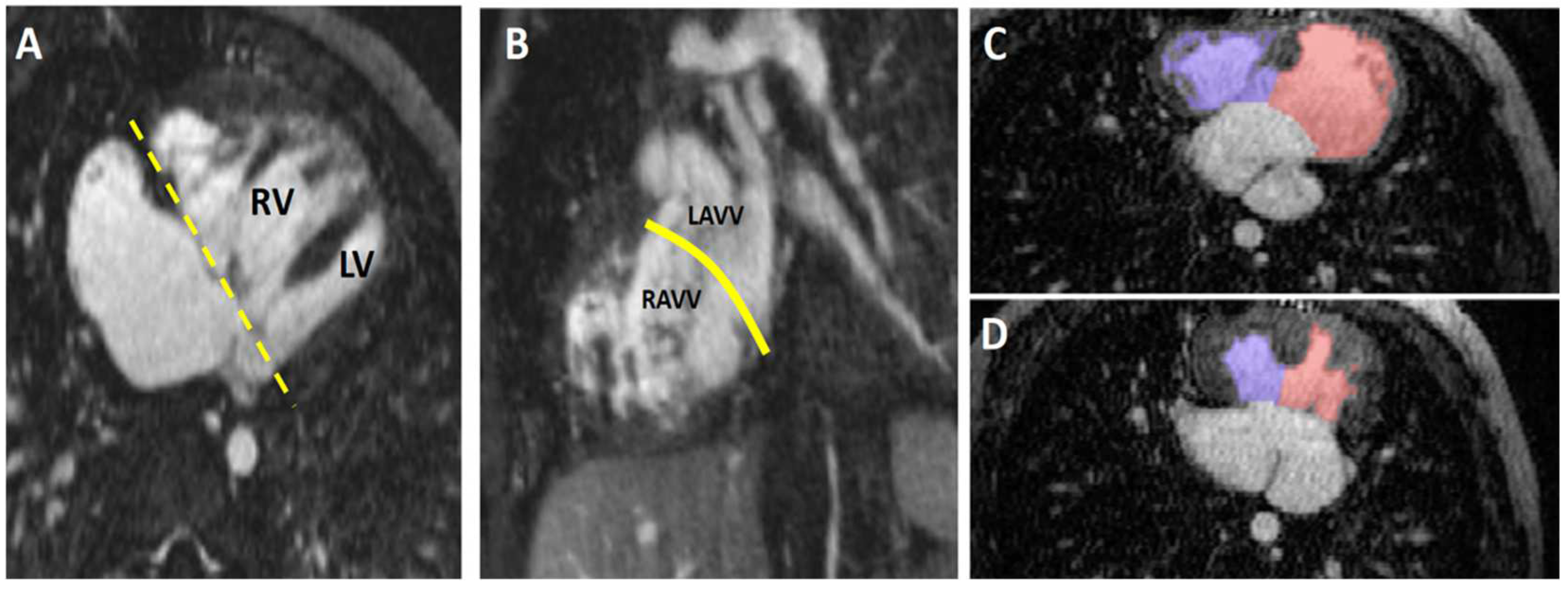 Children | Free Full-Text | Ferumoxytol-Enhanced Cardiac Magnetic ...