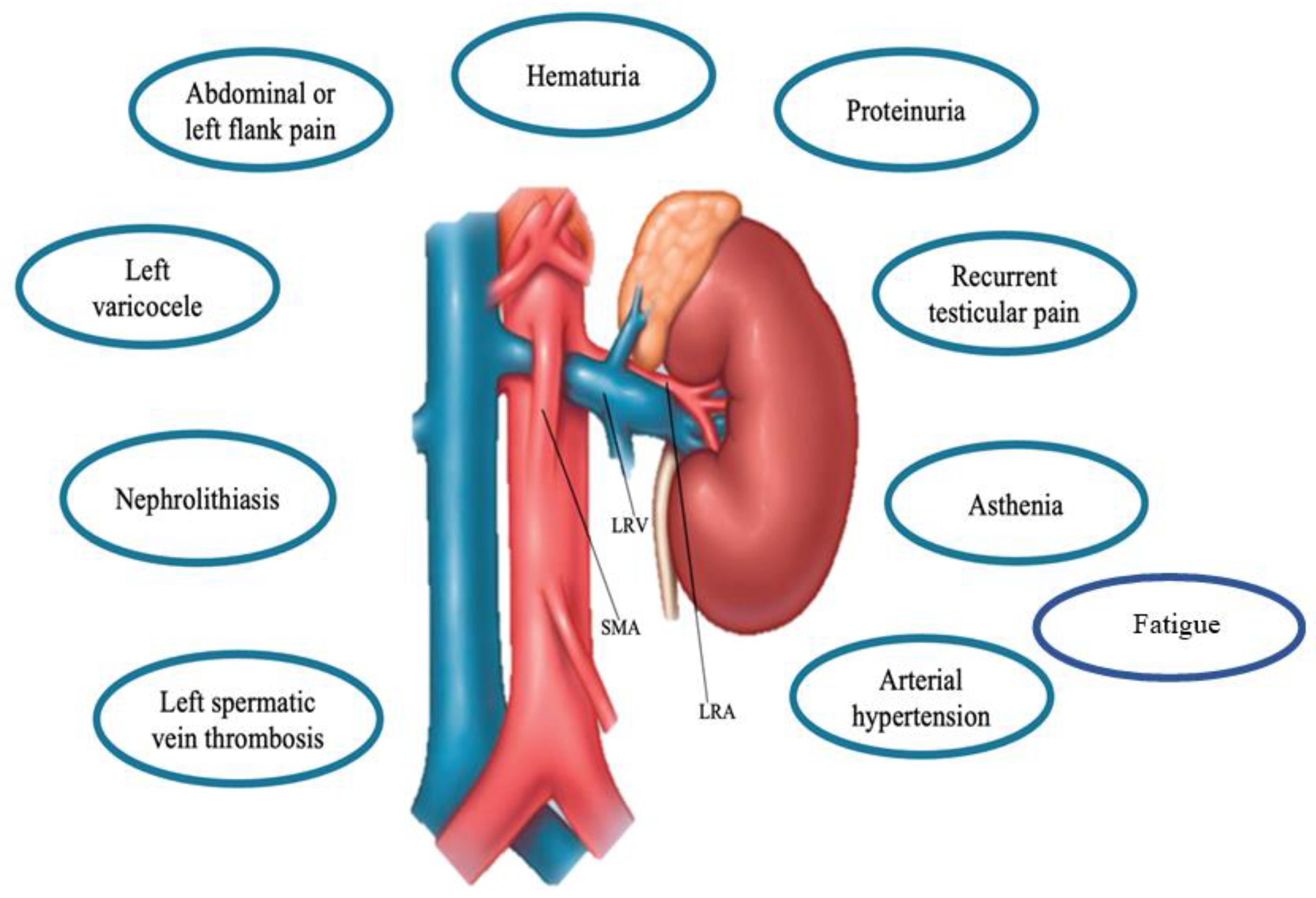 Renal Artery Nutcracker Syndrome At Michael Schiller Blog Renal Artery Nutcracker Syndrome At Michael Schiller Blog