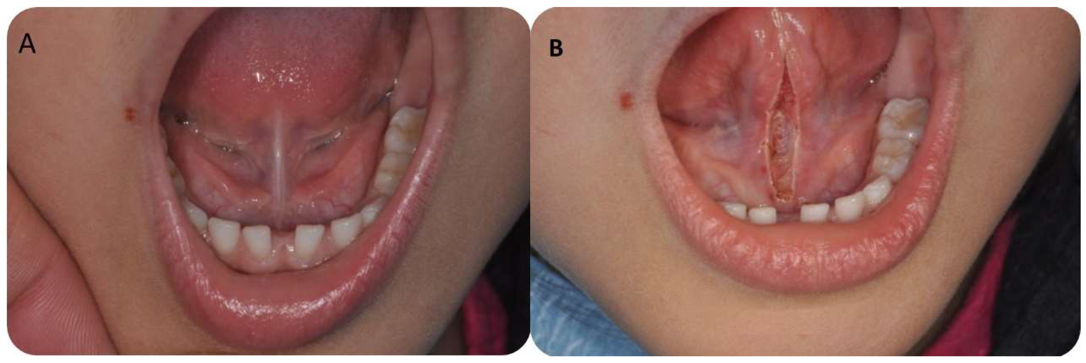 sublingual caruncle swelling