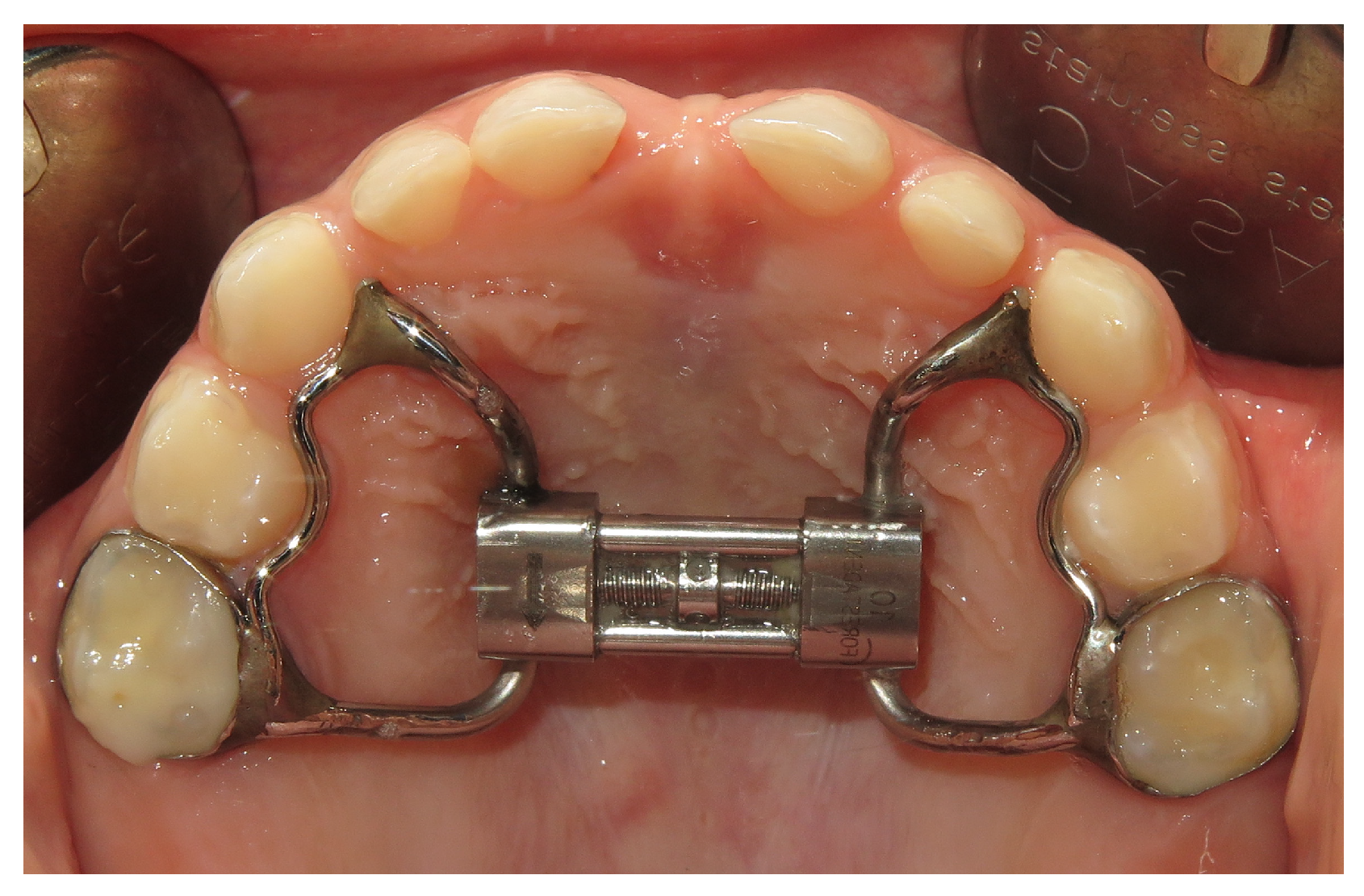 What is an expander ?  Read all you need to know here.
