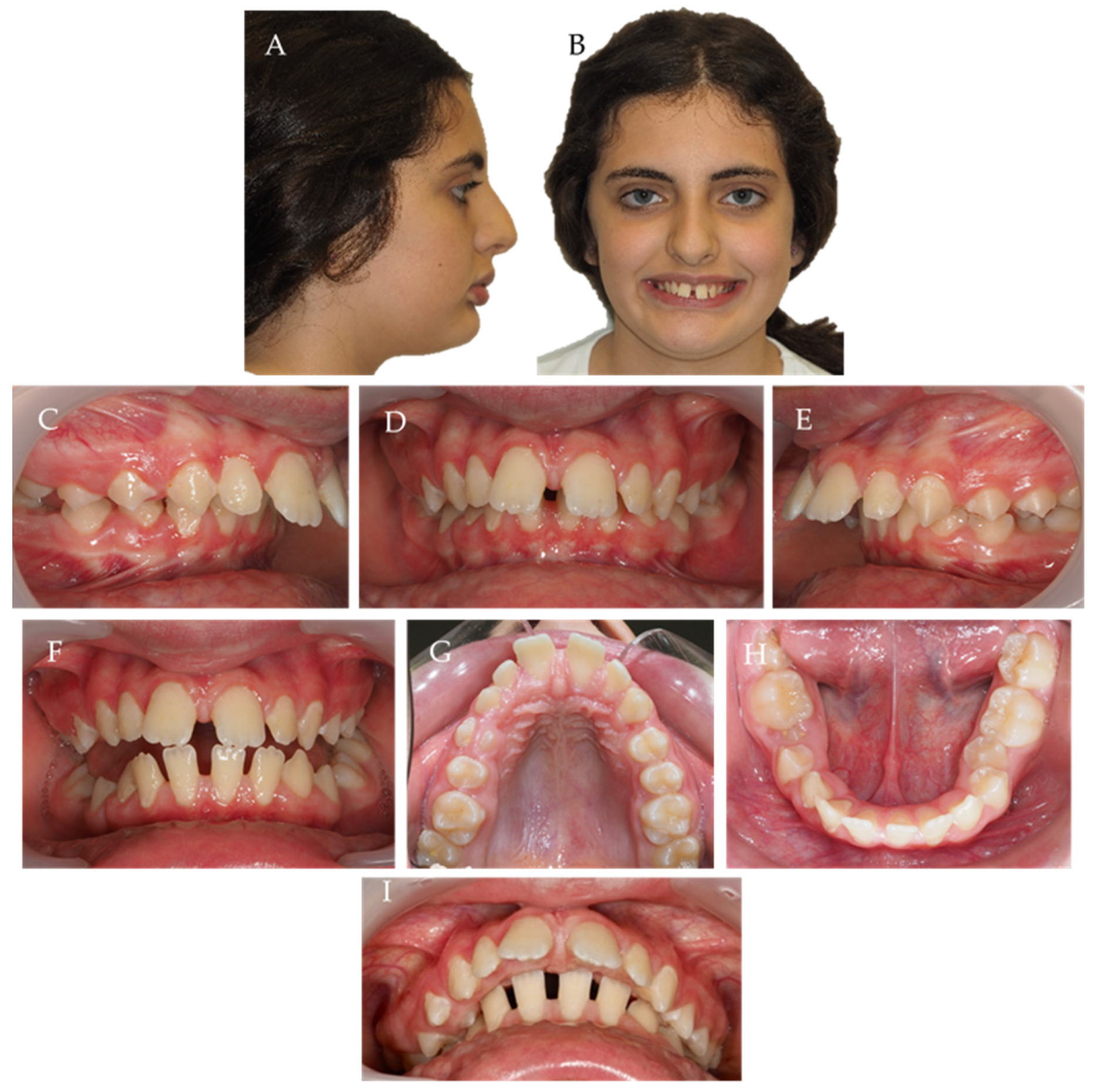 Children | Free Full-Text | Scissor Bite in Growing Patients: Case Report  Treated with Clear Aligners