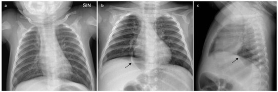 Retrocardiac Pneumomediastinum: Description of an Unusual Case and ...