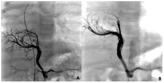 Children | Free Full-Text | Transcatheter Management of Pulmonary ...