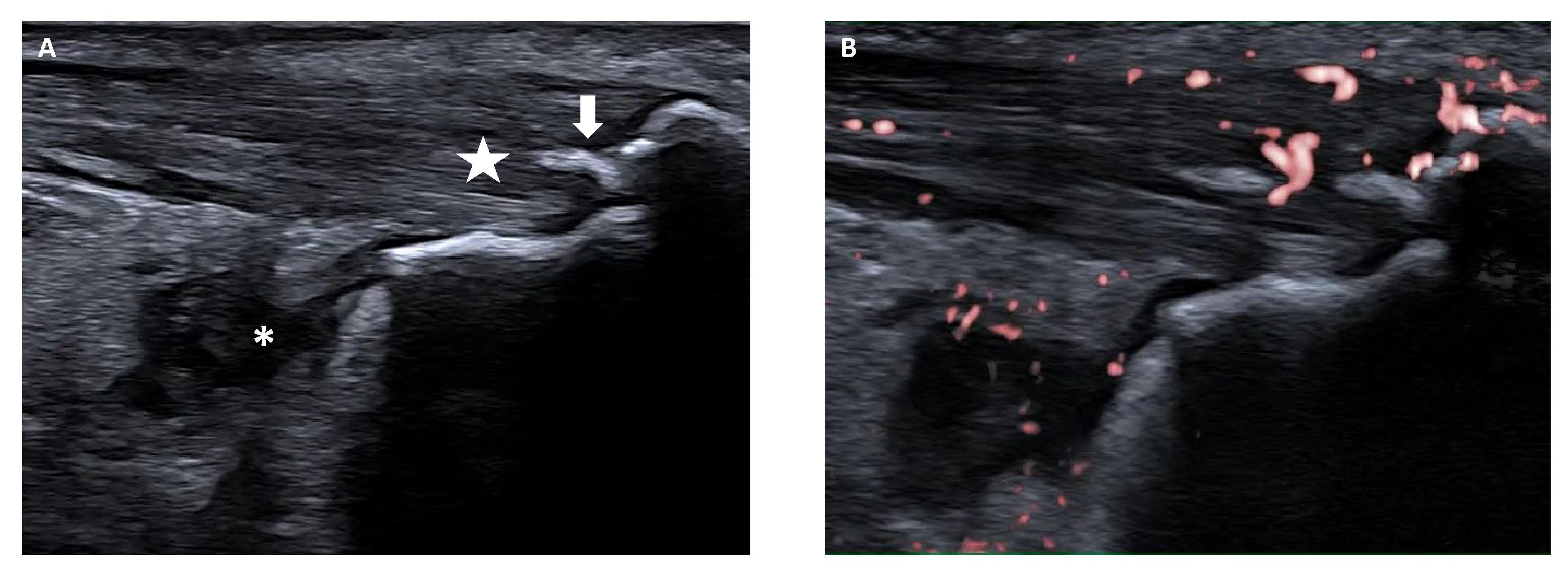 Advances in the Diagnosis and Treatment of Enthesitis-Related Arthritis