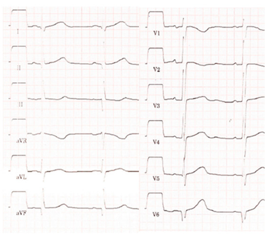 Dilated Cardiomyopathy Due to Alimentary Iron Deficiency