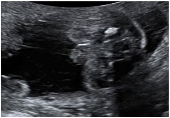 Prenatal Features of MIRAGE Syndrome—Case Report and Review of the ...