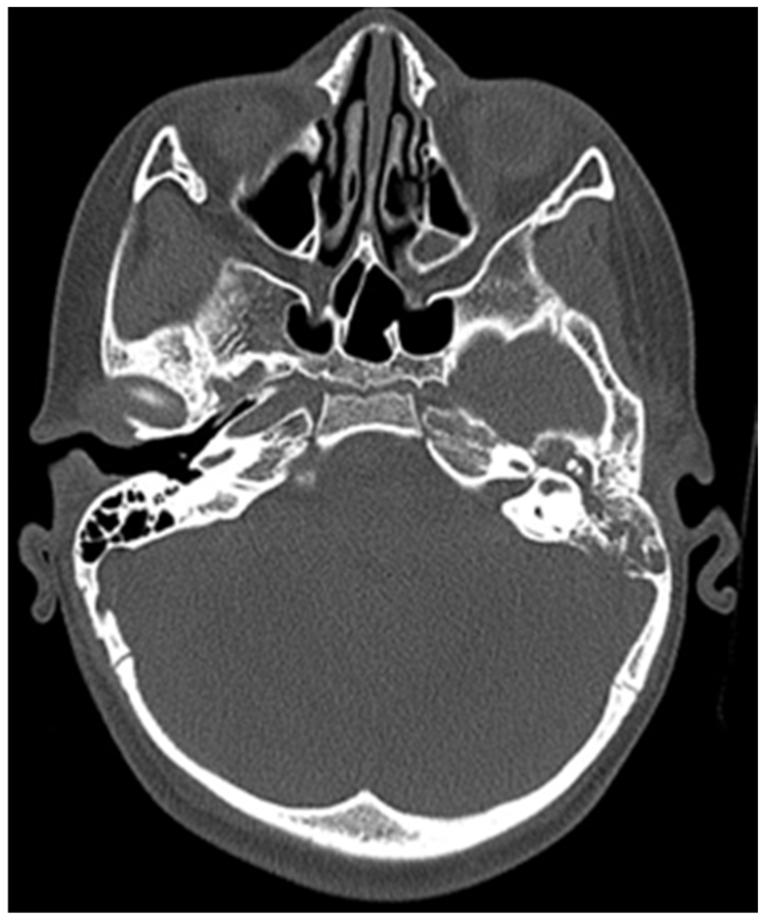 Rhabdomyosarcoma Of The Middle Ear Case Report