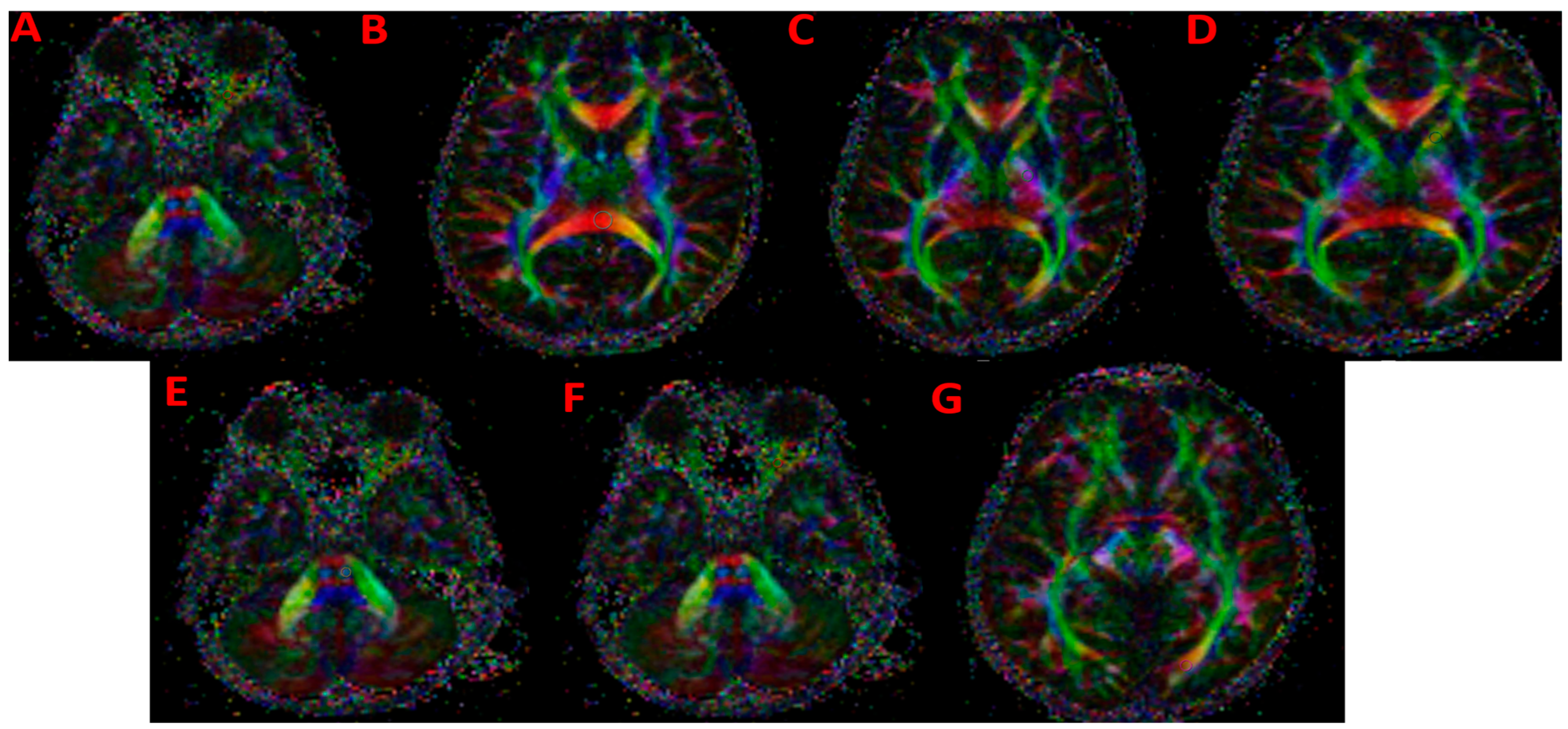 Microstructural White Matter Alterations in Pediatric Idiopathic ...