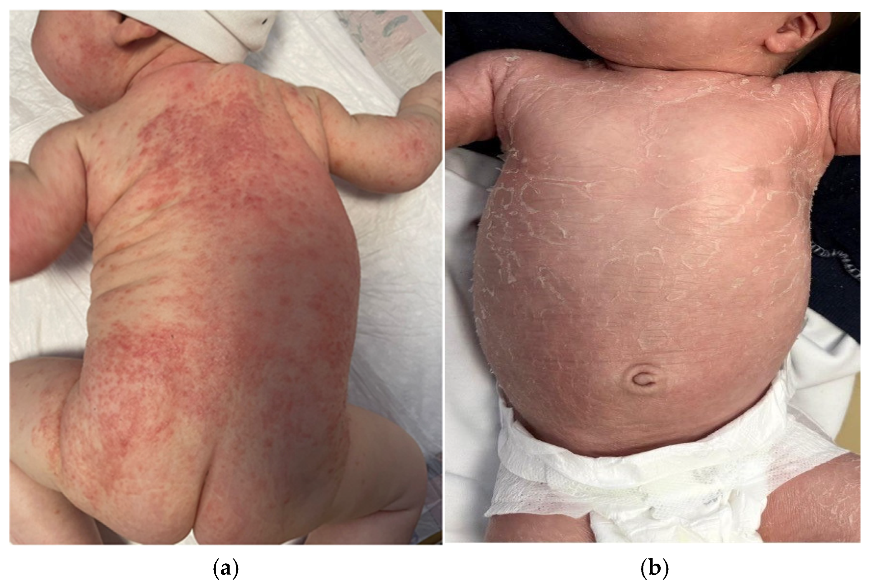 Atopic Dermatitis in Children: Differential Diagnosis and Mimickers