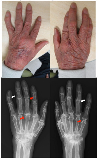Dactylitis With Psoriatic Arthritis: Causes & More