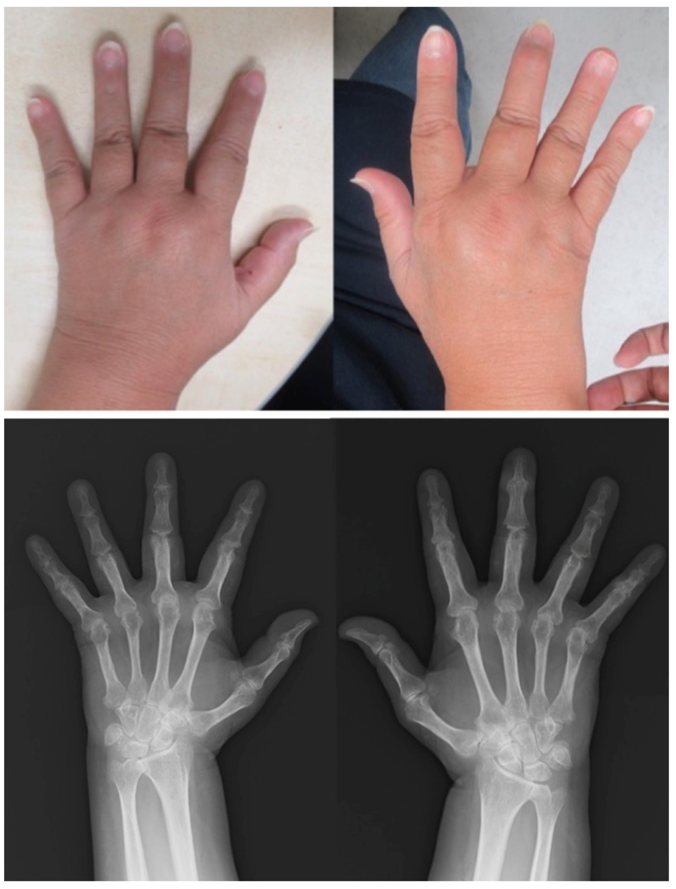 Most common form of arthritis - MEDizzy
