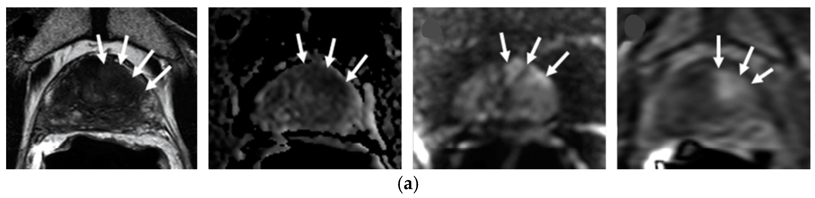 Magnetic Resonance Imaging Techniques For Post-treatment Evaluation 