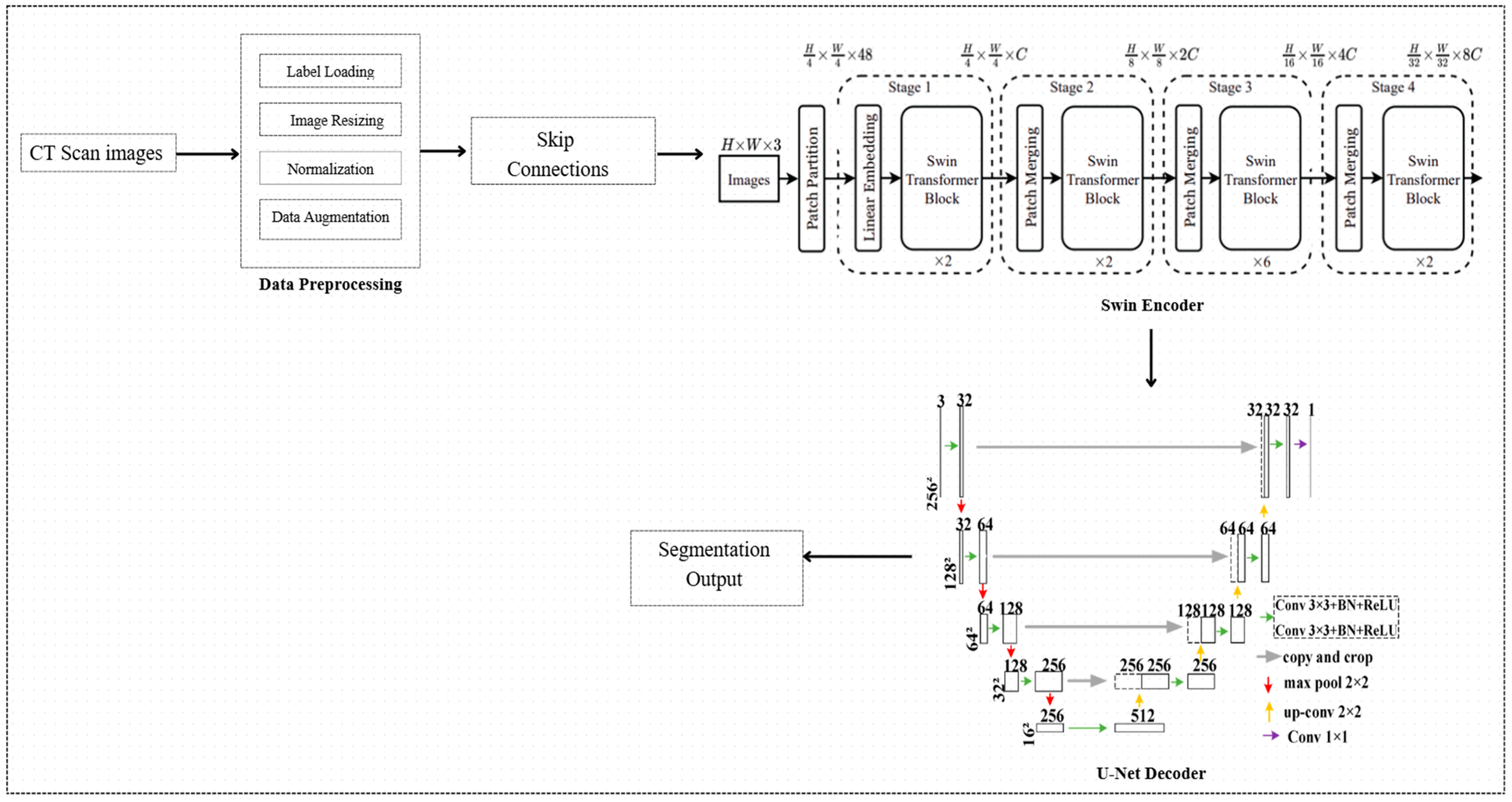 Hybrid Transformer Model with Augmentation for Kidney Tumor Segmentation
