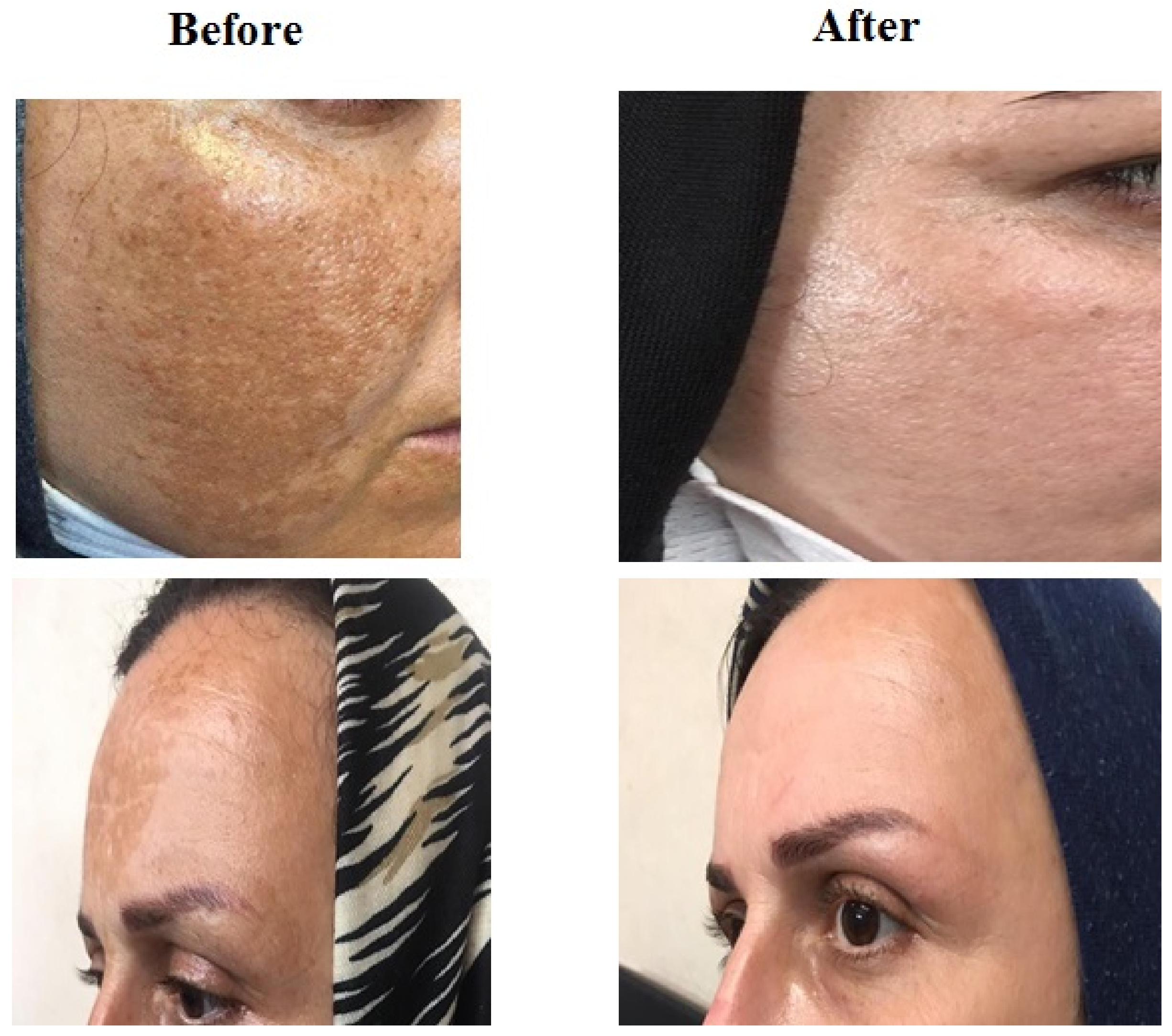 Gooi Ramkoers tij Cosmetics | Free Full-Text | Comparative Efficacy of Fractional CO2 Laser  and Q-Switched Nd:YAG Laser in Combination Therapy with Tranexamic Acid in  Refractory Melasma: Results of a Prospective Clinical Trial