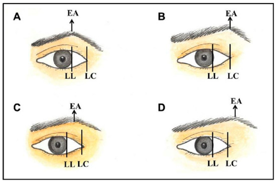 Brow lift and shaping is an excellent technique to rejuvenate your eyes.