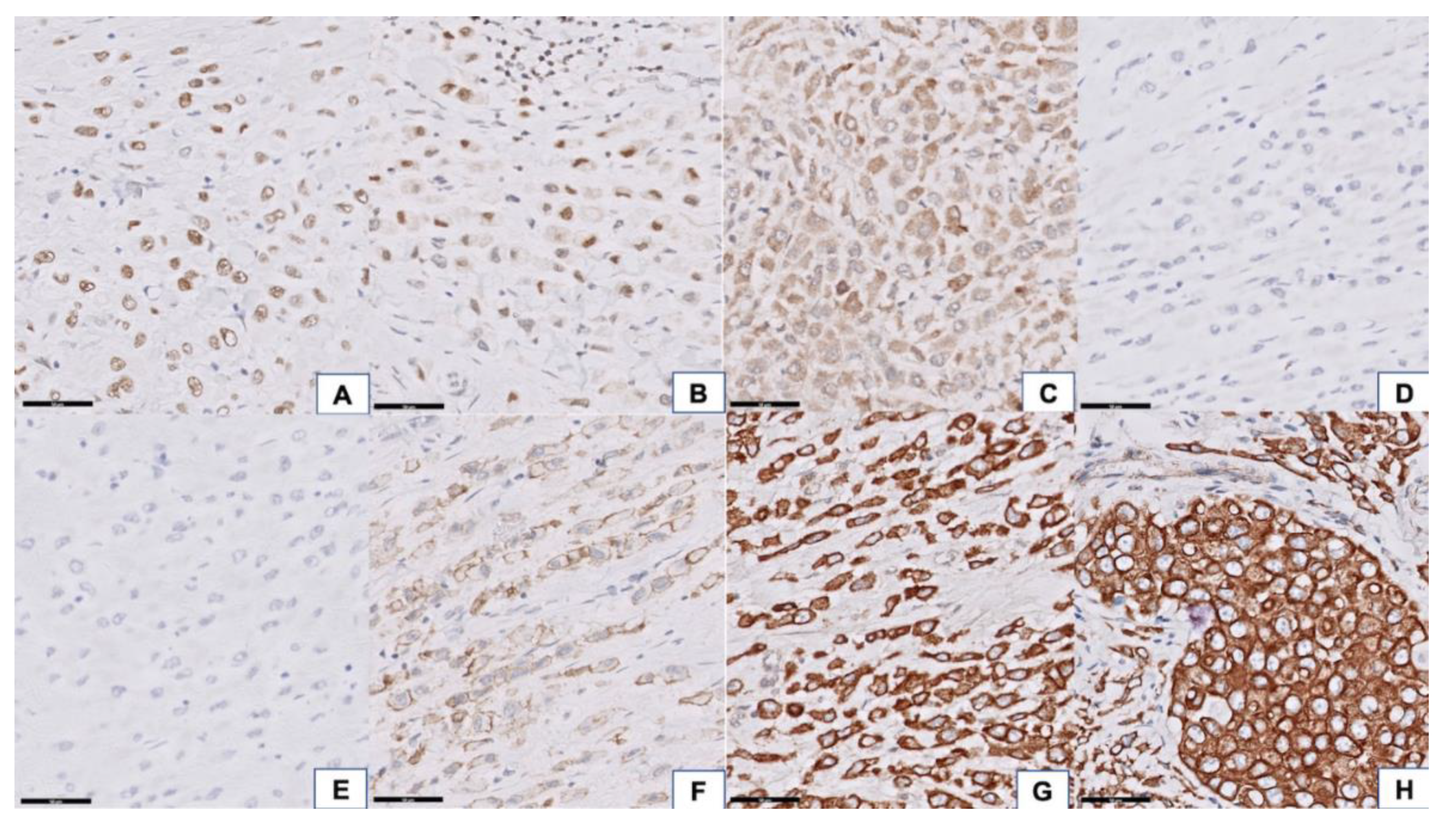 Signet ring cell carcinoma stock image. Image of pathology - 121118517