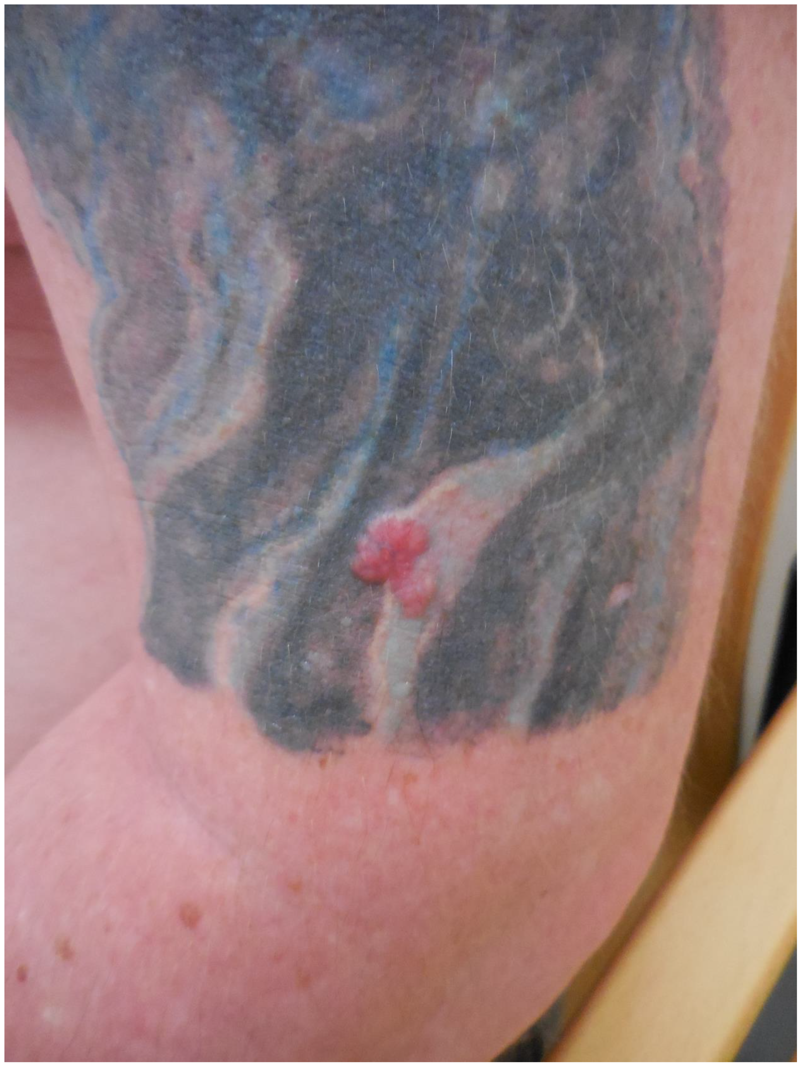 Current Oncology | Free Full-Text | Cutaneous Malignancies in Tattoos, a  Case Series of Six Patients