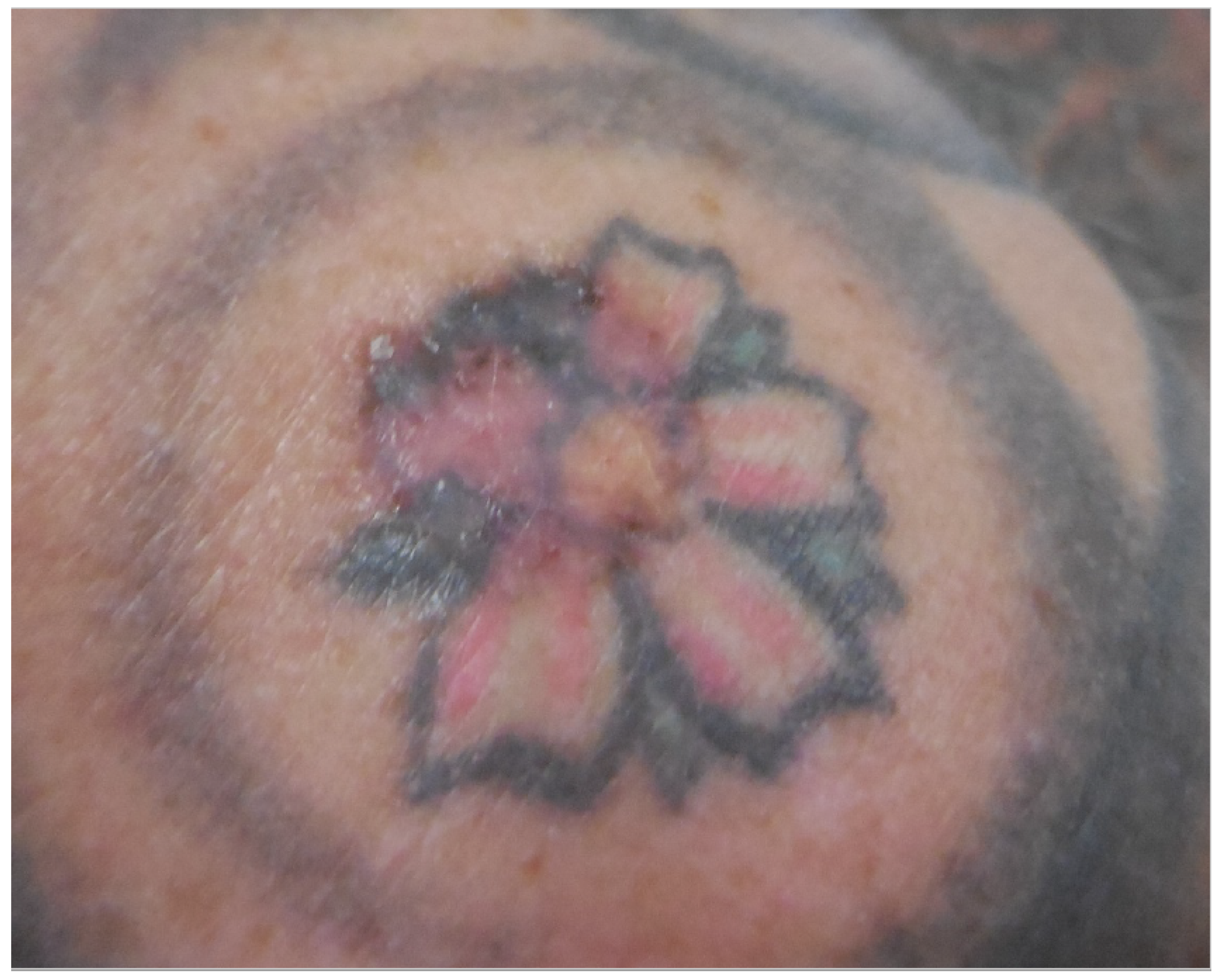 Current Oncology  Free FullText  Cutaneous Malignancies in Tattoos a  Case Series of Six Patients