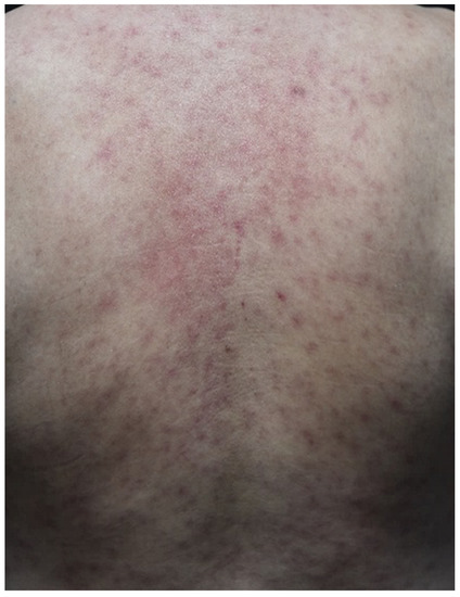 Strange Rash on breasts? picture included - Breastfeeding, Forums