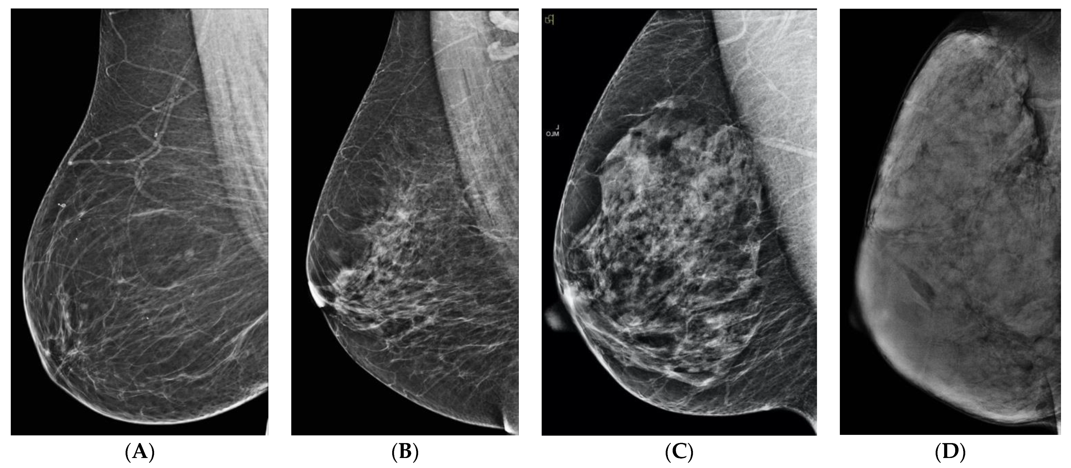 Dense Breasts: Các bạn có biết rằng vú đặc gấp 4 lần khả năng phát hiện ung thư vú so với vú bình thường? Hãy xem hình ảnh này để hiểu rõ hơn về vú đặc và tại sao đây là một chủ đề quan trọng trong chăm sóc sức khoẻ phụ nữ.