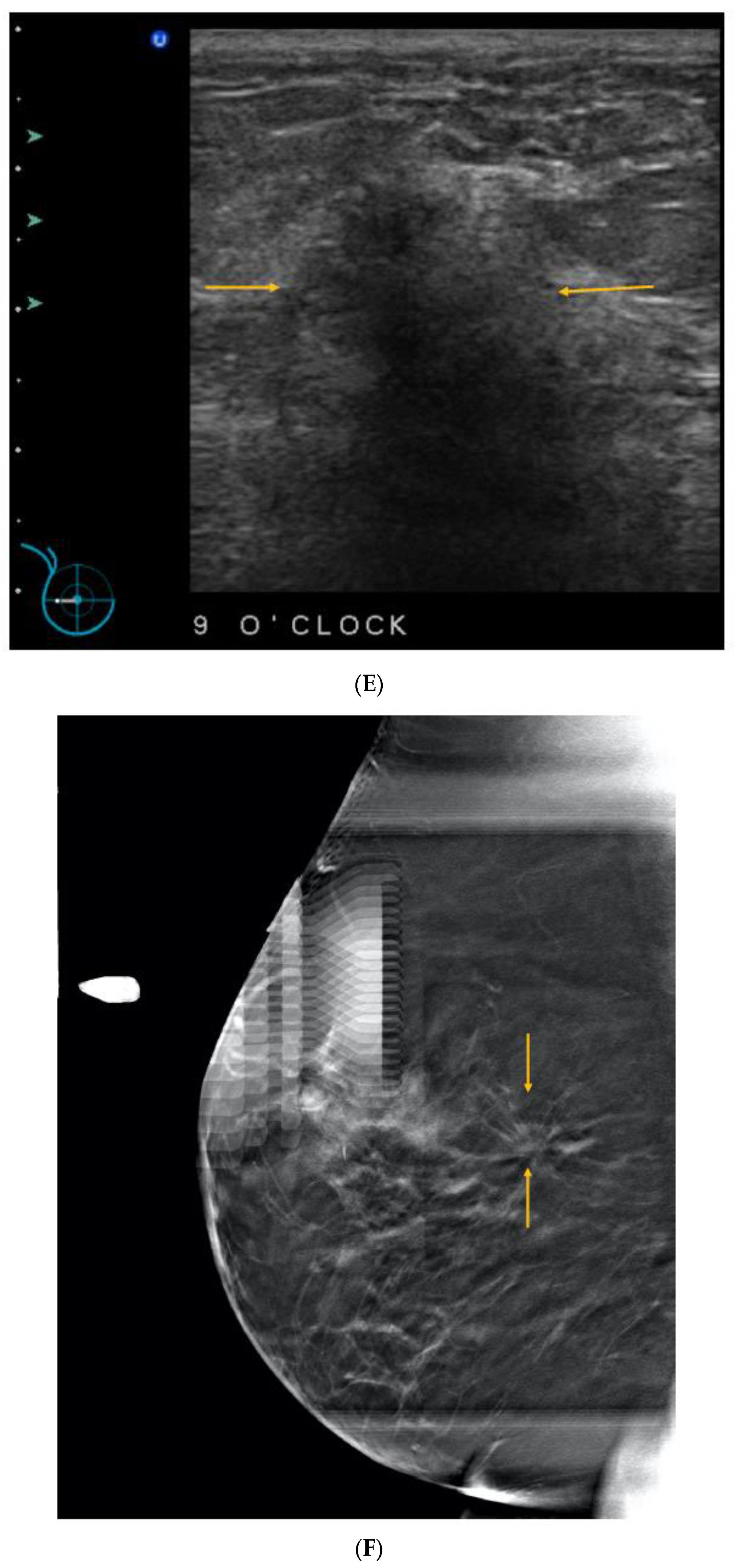 A 62-year-old woman with  non-dense  breast composition and small