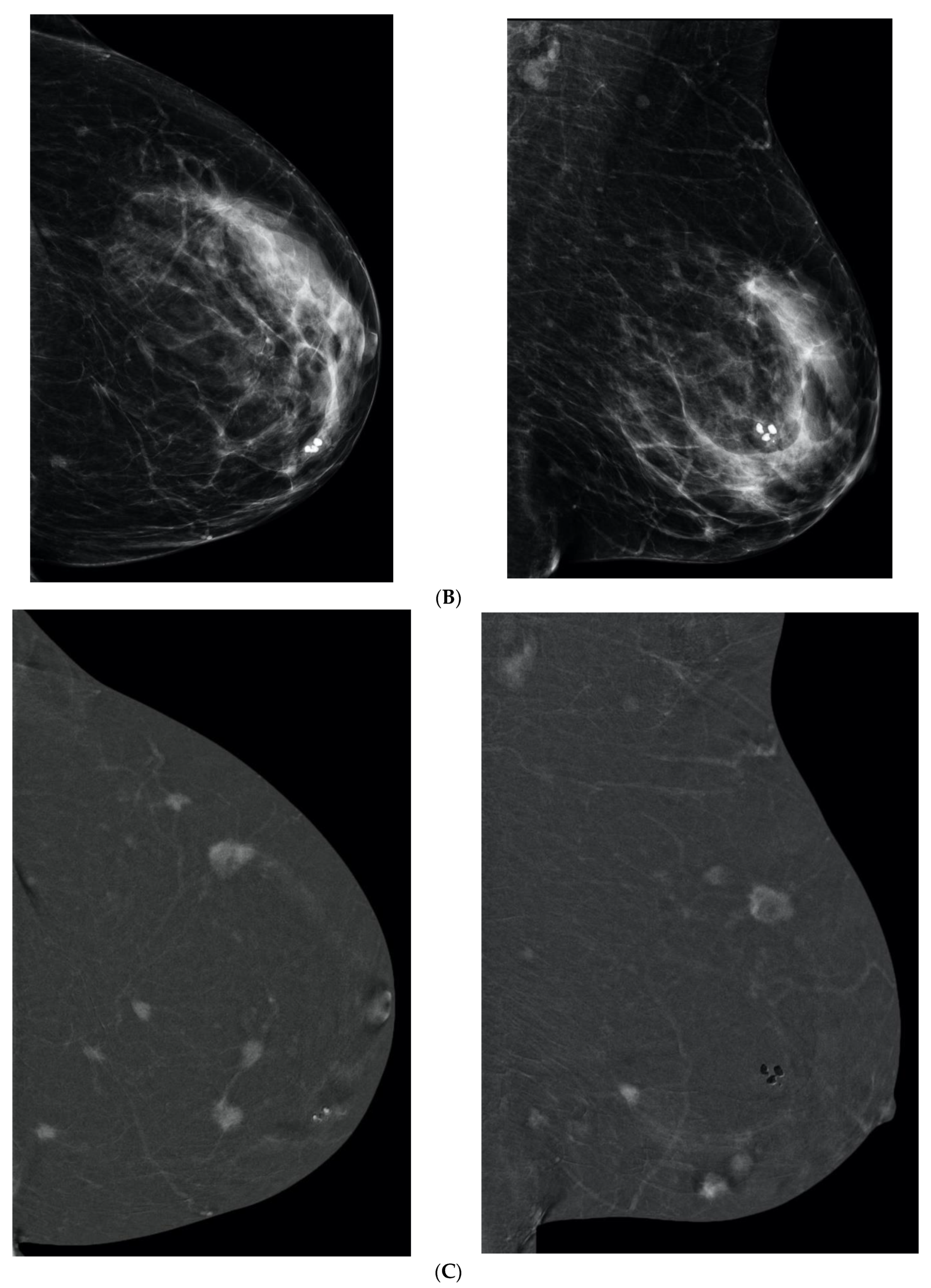 a, b Mammogram of 63-year-old woman. The LCC (left cranialcaudal