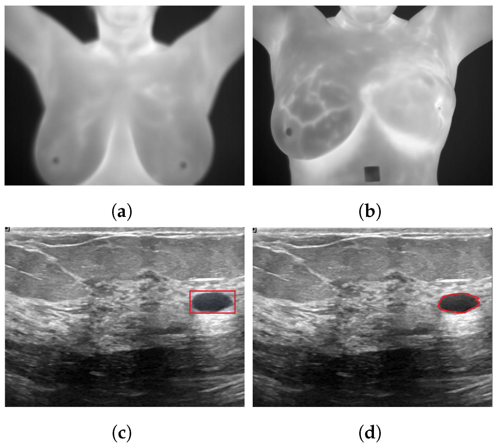 A -Preoperative examination showing evident breast size asymmetry; B