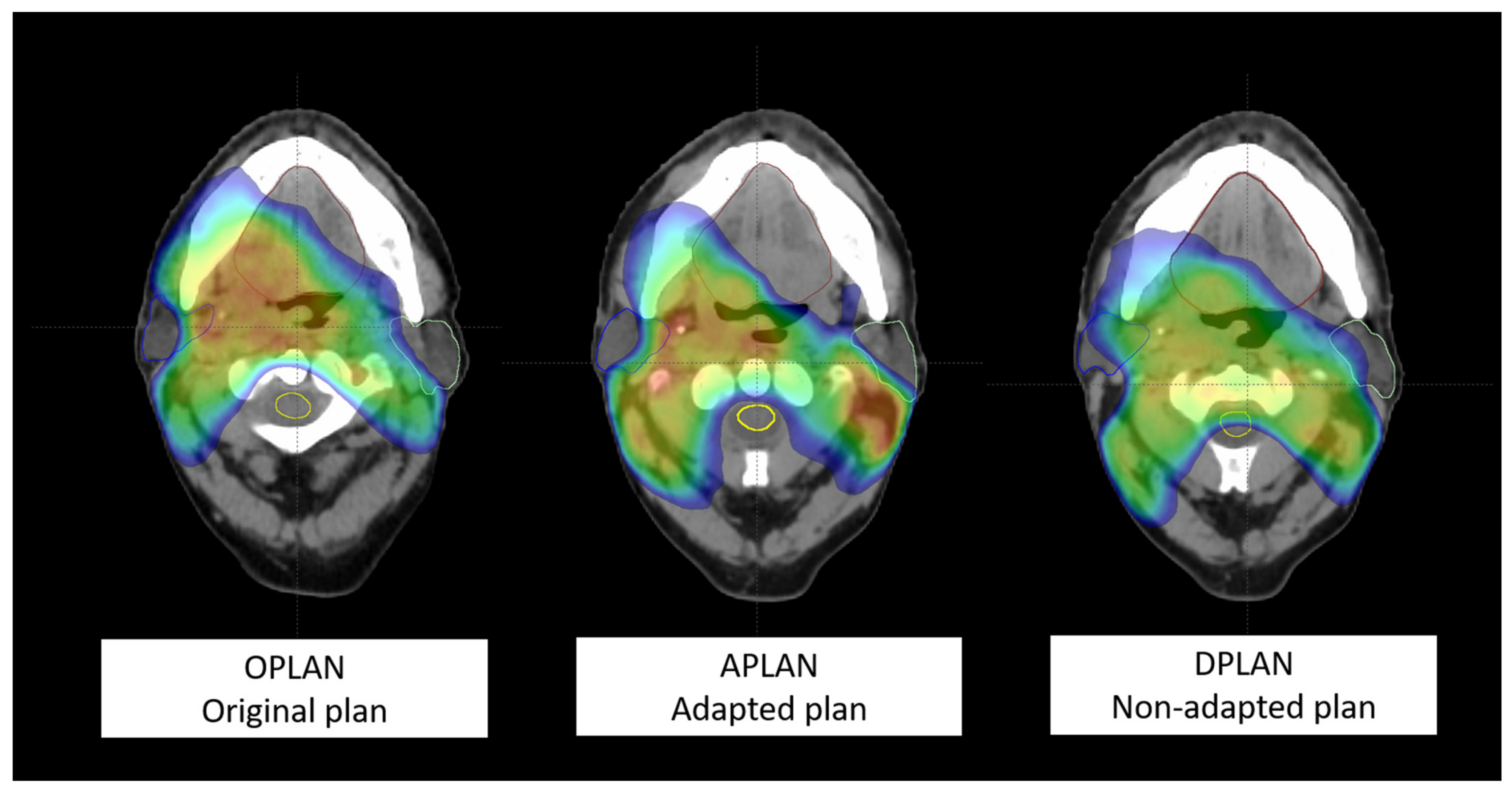 Current Oncology Free Full Text Adaptive Volumetric Modulated Arc