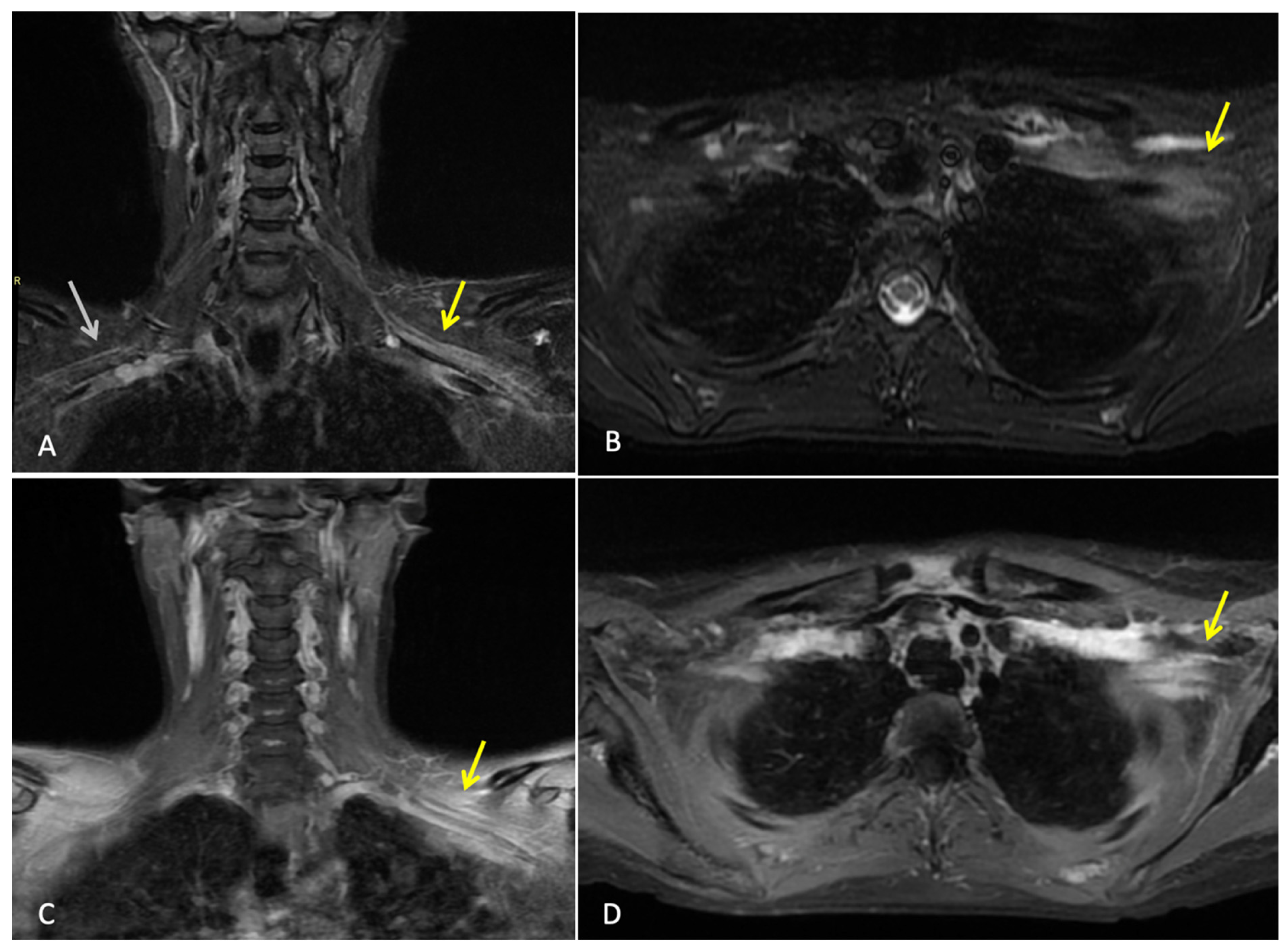 A Perplexing Plexopathy After Pembrolizumab Therapy in Early-Stage ...