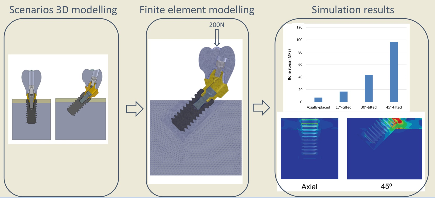 Biomechanical comparison of different prosthetic materials and posterior  implant angles in all-on-4 treatment concept by three-dimensional finite  element analysis