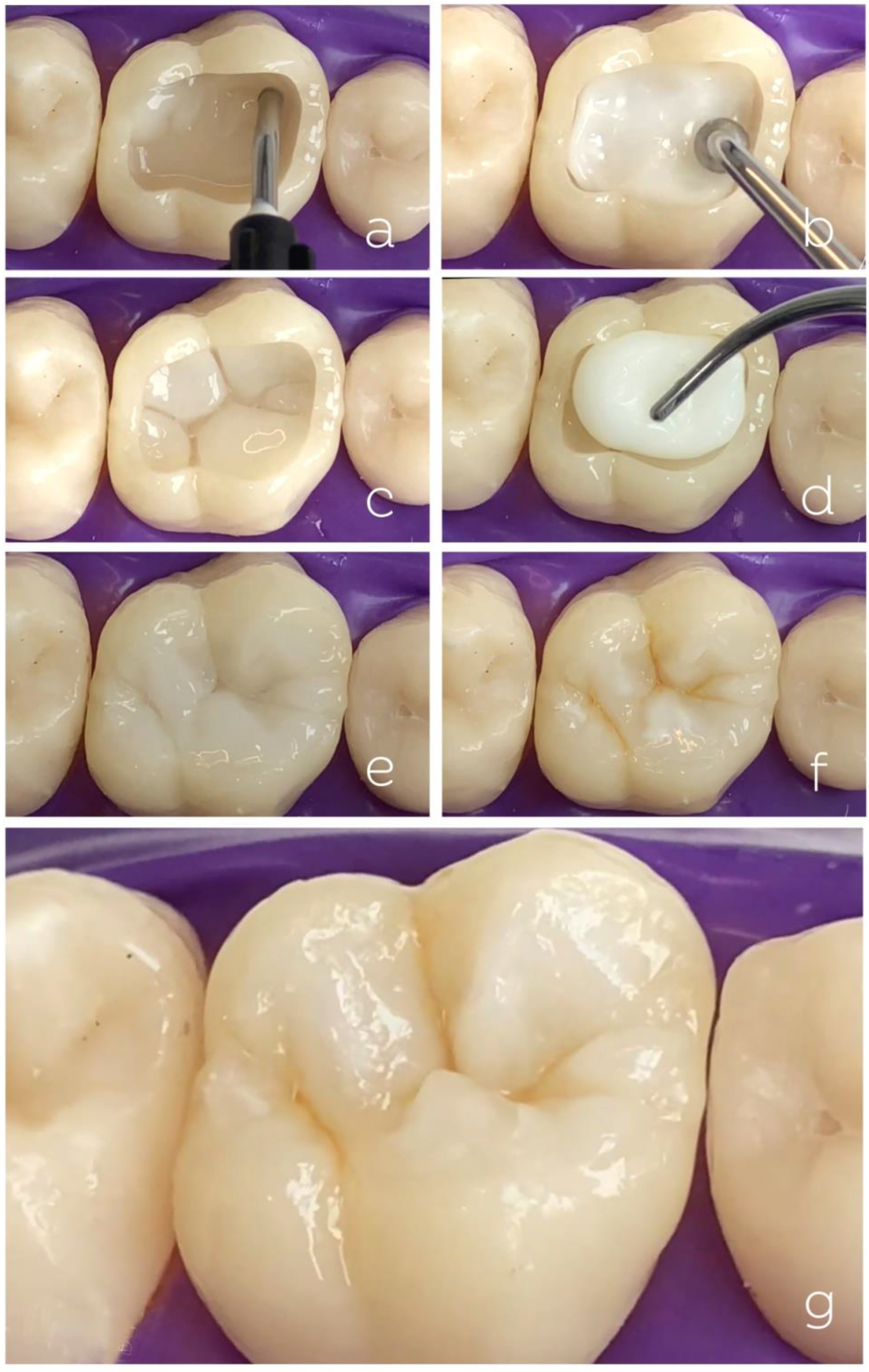 Resin Composites In Posterior Teeth Clinical Performance And Direct Resin Composites In Posterior Teeth Clinical Performance And Direct