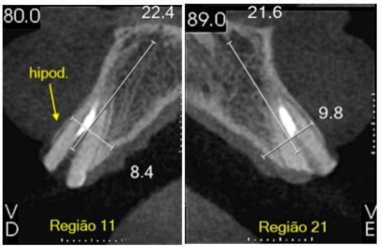 image of Digital Planning for Immediate Implants in Anterior Esthetic Area: Immediate Result and Follow-Up after 3 Years of Clinical Outcome&mdash;Case Report