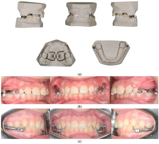 Dentistry Journal | Free Full-Text | The Efficacy of the RME II System ...