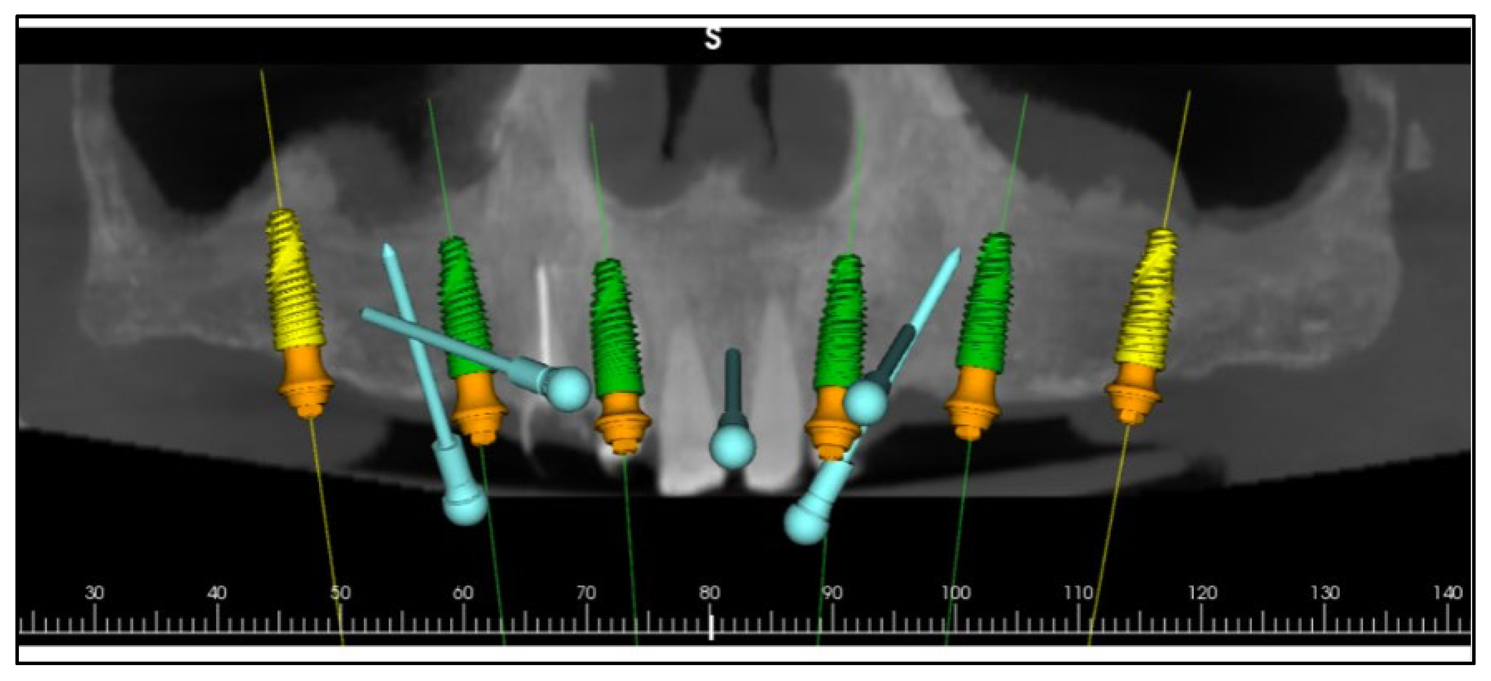 Stackable Implants Facially Driven Full-Arch Implant Rehabilitation with Stackable ...