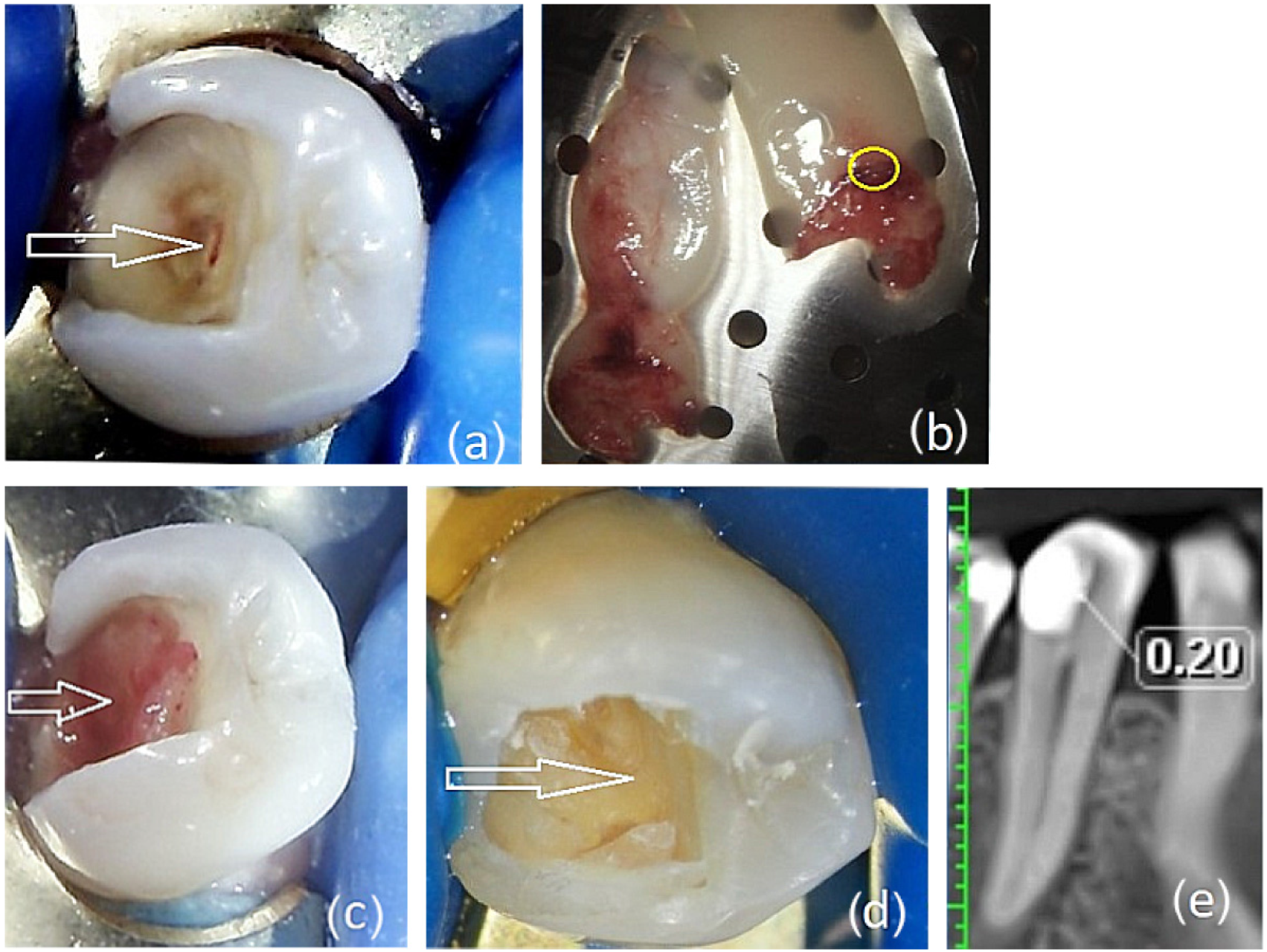 Direct Pulp Capping of Dental Pulp with Two Different Autologous ...